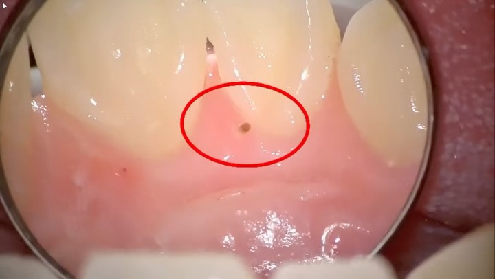 ããã«ã¡ã¯ïŒ
æ¥æ¬é¡åŸ®é¡æ¯ç§åŠäŒèªå®æ¯ç§è¡ç士ã®å¹³å°Ÿã§ãðŠ·
æ¯åšç
ã®æ²»çã¯ãçããããããããšããã€ã¡ãŒãžã¯ãããŸãããïŒ
ã²ããæ¯ç§ã¯ãªããã¯ã§ã¯ããã€ã¯ãã¹ã³ãŒãã䜿ã£ãŠæ¡å€§èŠéã§æœè¡ãããããæ¯èãå·ã€ããã«åºè¡ãšçã¿ã®å°ãªãæ²»çãè¡ã£ãŠãããŸãâš
èçŒã§ã¯ã¿ããªã现ããªæ¯ç³ãèŠèœãšããŸããð
ãŸãæ£ããæ¯ãã©ã·ã®åœãŠæ¹ããã²ãšããã²ãšãã«é©ããæ¯ãã©ã·ã®ææ¡ãªã©ããäŒããããŠããã ããŠãããŸãðª¥
æ¯å»è
ãããããäžå®ãããæ¹ã»ã©å蚺ãããããããŸãâš
#æ¯åšç
æ²»ç #æ¯ç³é€å» #ãã€ã¯ãã¹ã³ãŒã #æ¯å»è
#ã²ããæ¯ç§ã¯ãªããã¯