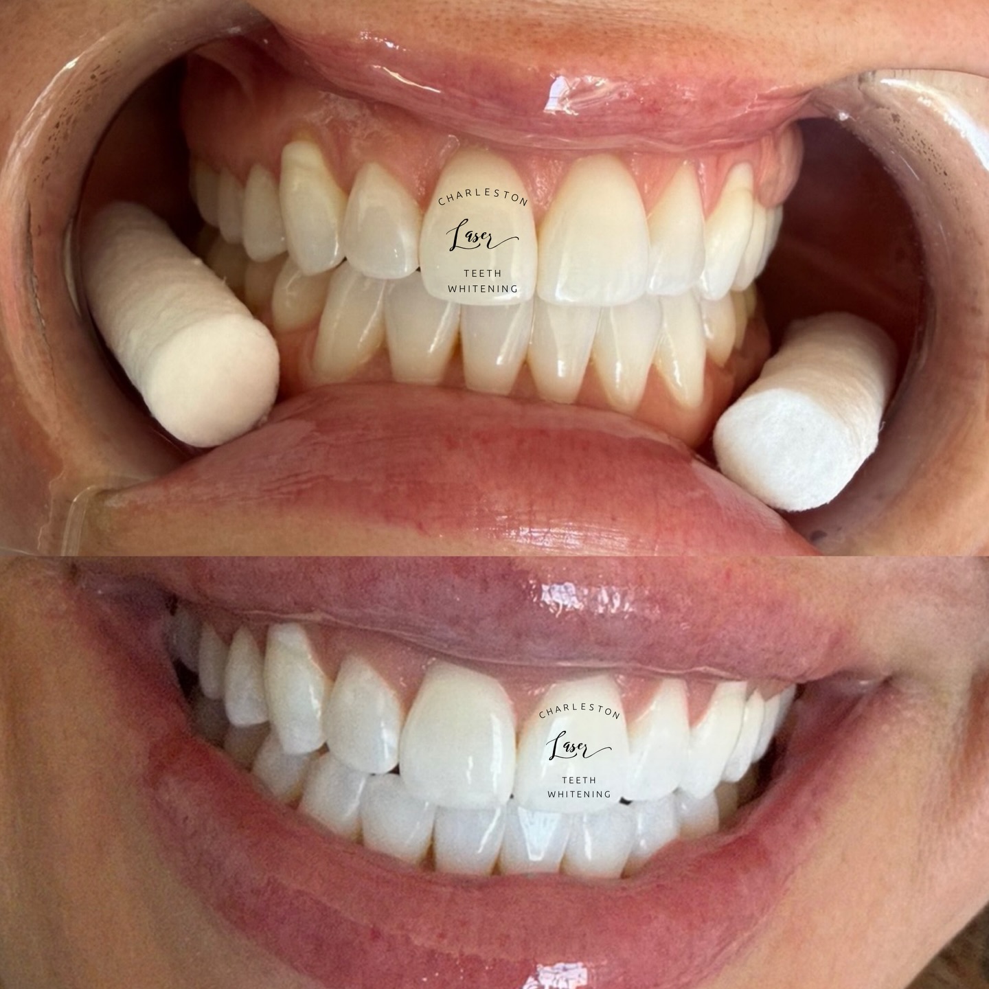 Spring time ready! 🌷
Book your teeth whitening now!
www.CharlestonLaserTeethWhitening.com
#teethwhitening #charlestonteethwhitening #charleston #charlestonsc #charlestonlaserteethwhitening mountpleasant mountpleasantsc kiawahisland kiawahjamesisland westashley isleofpalms downtowncharleston sullivansisland johnsisland johnsisland northcharleston northcharlestonsc folly follybeach laserteethwhitening