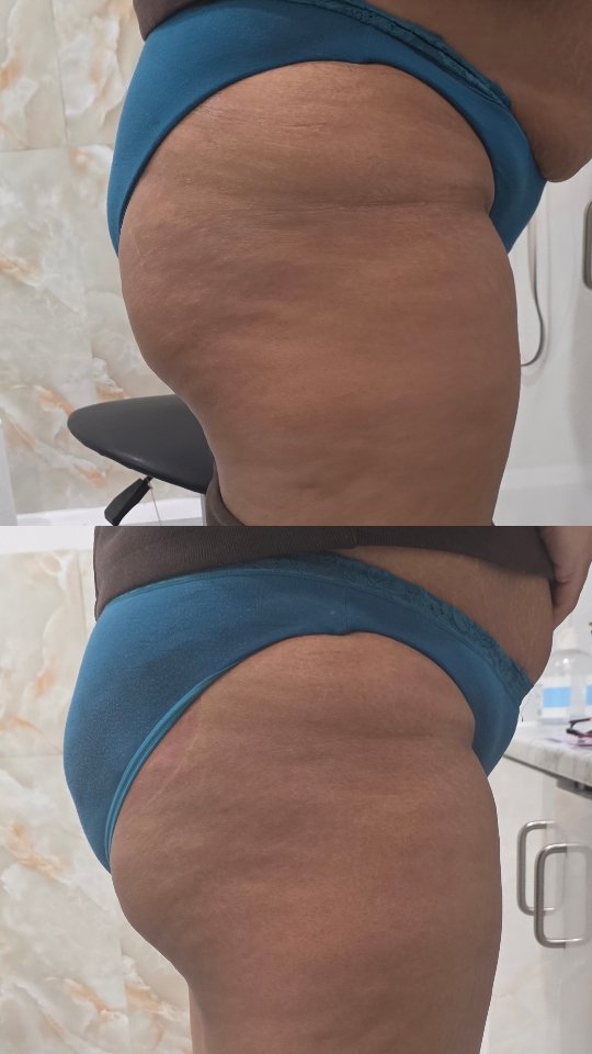 ✨ Ready for instant results? ✨
3 sessions £99. All summer xxx
Get that smooth, sculpted look with our BBL treatment at an unbeatable price just £45 per session! 💫
✔️ Visible results from your very first session
✔️ Non-invasive & relaxing
✔️ Perfect for instant results
Don’t wait to feel confident in your skin book your session today! 💖
📍 Visit us: hmbsalon.co.uk
📩 DM us to book
#BBLTreatment #nonivasive #BeautyDeals #LondonBeauty HMBSalon