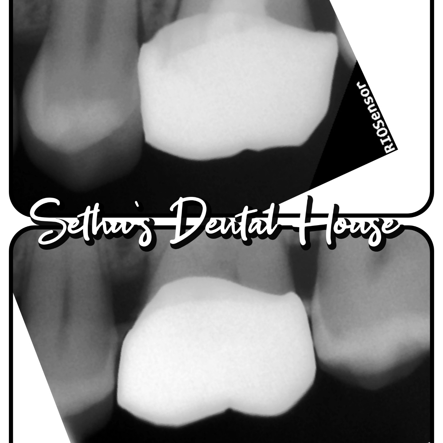 The above and below pics are the IOPA xrays of two different patient's. The above pic shows the xray of a crown done elsewhere and is yet to be changed. The below pic is the post cementation xray of the crown done at our clinic.
Precise, Pleasant and Aesthetic Dentistry at Sethu's Dental House, Chrompet, Chennai by Dr. Sethuraman Ramadoss MDS Prosthodontist and Implantologist.
The importance of post cementation x rays :