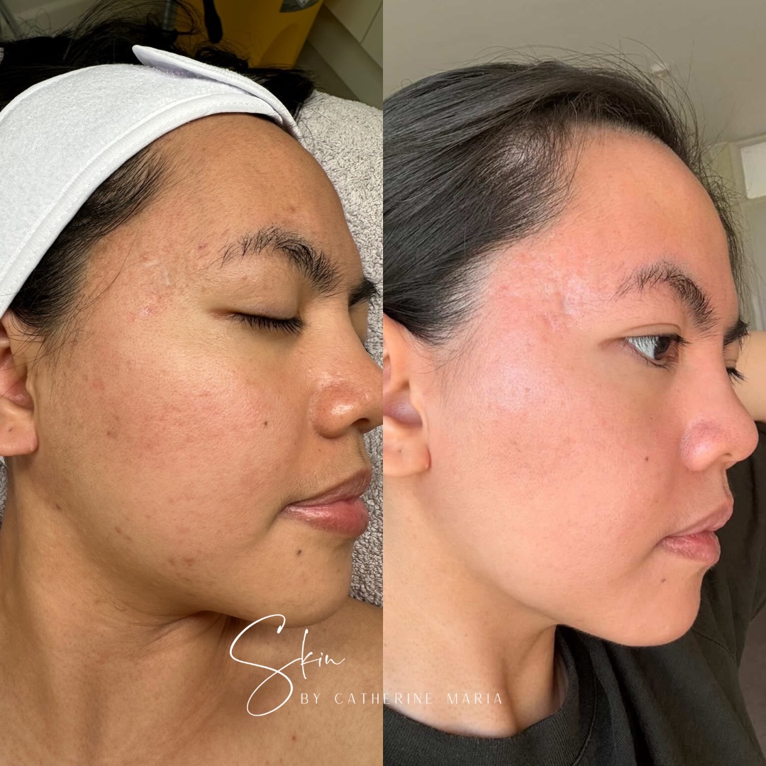 PROGRESS 🤍
This didn’t happen overnight, in fact we’ve been working together for almost 3 years. It’s about getting the skin to a place where it feels stronger and just healthier overall.
There’s no magic treatment or a one-off facial - it’s about consistency, having the right treatments at the right time, and a routine that supports the skin instead of stripping it and causing long-term damage and inflammation.
Over time, skin has become more even, less congested and has that natural glow.
If you’re ready to take a long-term approach to your skin, book your consultation via the link in my bio.
📍 Aylesbury, Buckinghamshire
📞 07759567391
📩 info@skinbycatherinemaria.com
🌍 www.skinbycatherinemaria.com
#aylesbury #aylesburybusiness #aylesburybeauty #aylesburyvale #aylesburytown