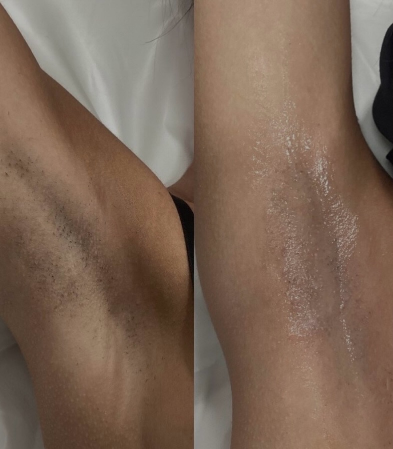 Summer is around the corner and this is your sign to book laser hair removal before it’s too late! 🫶🏼✨
