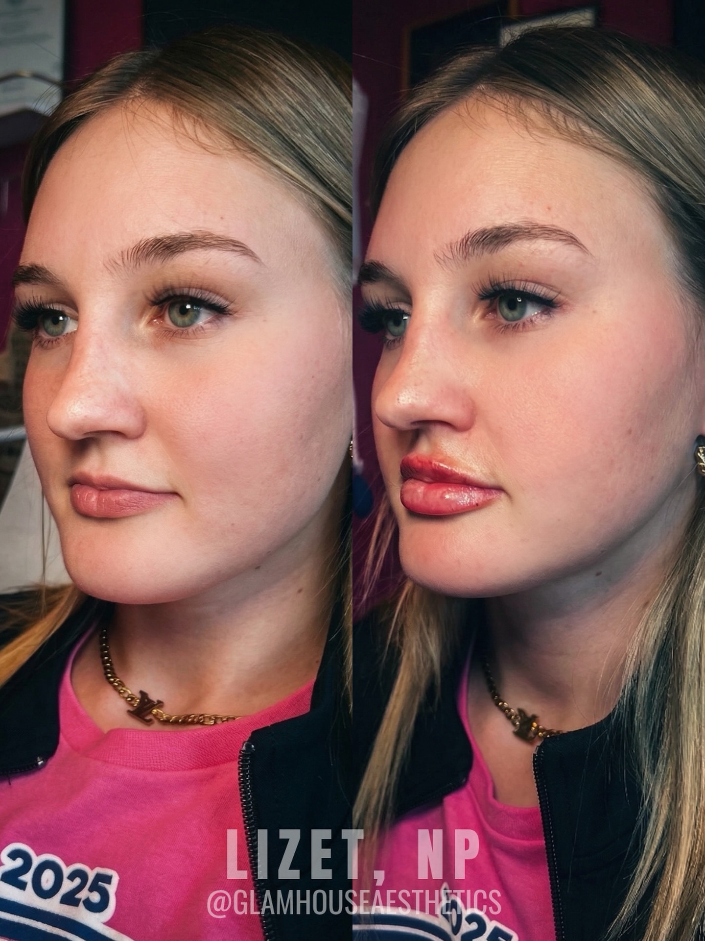 Defined Shape đ
This lip enhancement focused on balancing proportions, enhancing shape, and adding soft, hydrated volume.
Ready for your own lip refresh? Send us a message or book your consultation.
#GlamhouseAesthetics #SanAntonioMedspa #NewBraunfelsMedSpa #LipFiller #NurseInjector