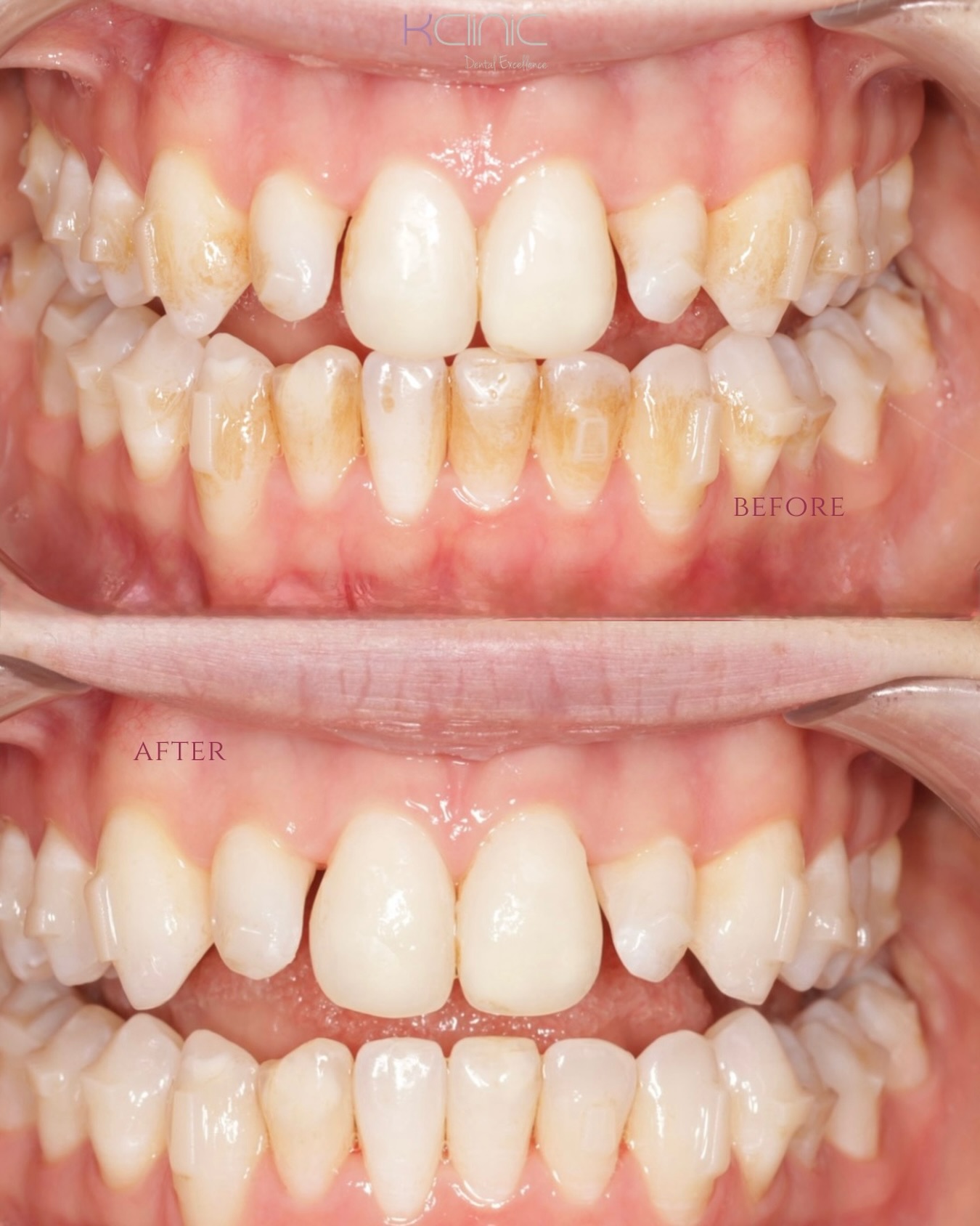 ✨ Incredible Airflow Transformation ✨
We’re excited to share this amazing before & after by our dental therapist Andrea at K Clinic 🤍
Using Airflow cleaning, stains and plaque have been gently removed, revealing a visibly brighter, healthier smile in just one visit 😍 The difference speaks for itself!
Airflow is perfect for:
• Removing stains from coffee, tea & smoking
• Deep yet gentle cleaning
• Instantly fresher, brighter smile
Thank you for trusting us with your smile! ✨
Thinking about refreshing your smile? Book your appointment with us today 🤍
0 % Finance options available
📍7 Windsor Way, Knutsford WA16 6JB
🌐 www.kclinic.co.uk
📱 07946 219 539
☎️ 01565 653480
#airflow#cleaning#beforeandafter#healthysmile#dentalcare