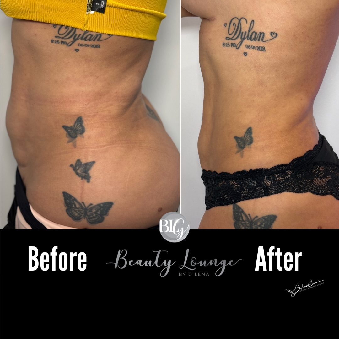 🚨 Si tienes grasa localizada + piel flojita en abdomen… esto te interesa
Este resultado fue con Endolaser Levage
Una tecnología avanzada que ayuda a definir, tensar y remodelar la zona sin una cirugía grande.
✨ Menos volumen
✨ Más firmeza
✨ Más cintura
✨ Más seguridad al verte al espejo
Este es el tipo de cambio que se ve elegante, natural y MUY favorecedor 💎
📲 Escribe “QUIERO” y te damos información.
🇺🇸🚨 If you have localized fat + loose skin in your abdomen… this is for you
This result was achieved with Endolaser Levage 🔥
An advanced technology that helps define, tighten, and remodel the area without major surgery.
✨ Less volume
✨ More firmness
✨ More waist definition
✨ More confidence when you look in the mirror
This is the kind of transformation that looks elegant, natural, and VERY flattering 💎
📲 Comment “I WANT IT” and we’ll send you all the info
#EndoliftResults #BeforeAfter #WaistContour #BodySculpting AestheticClinic