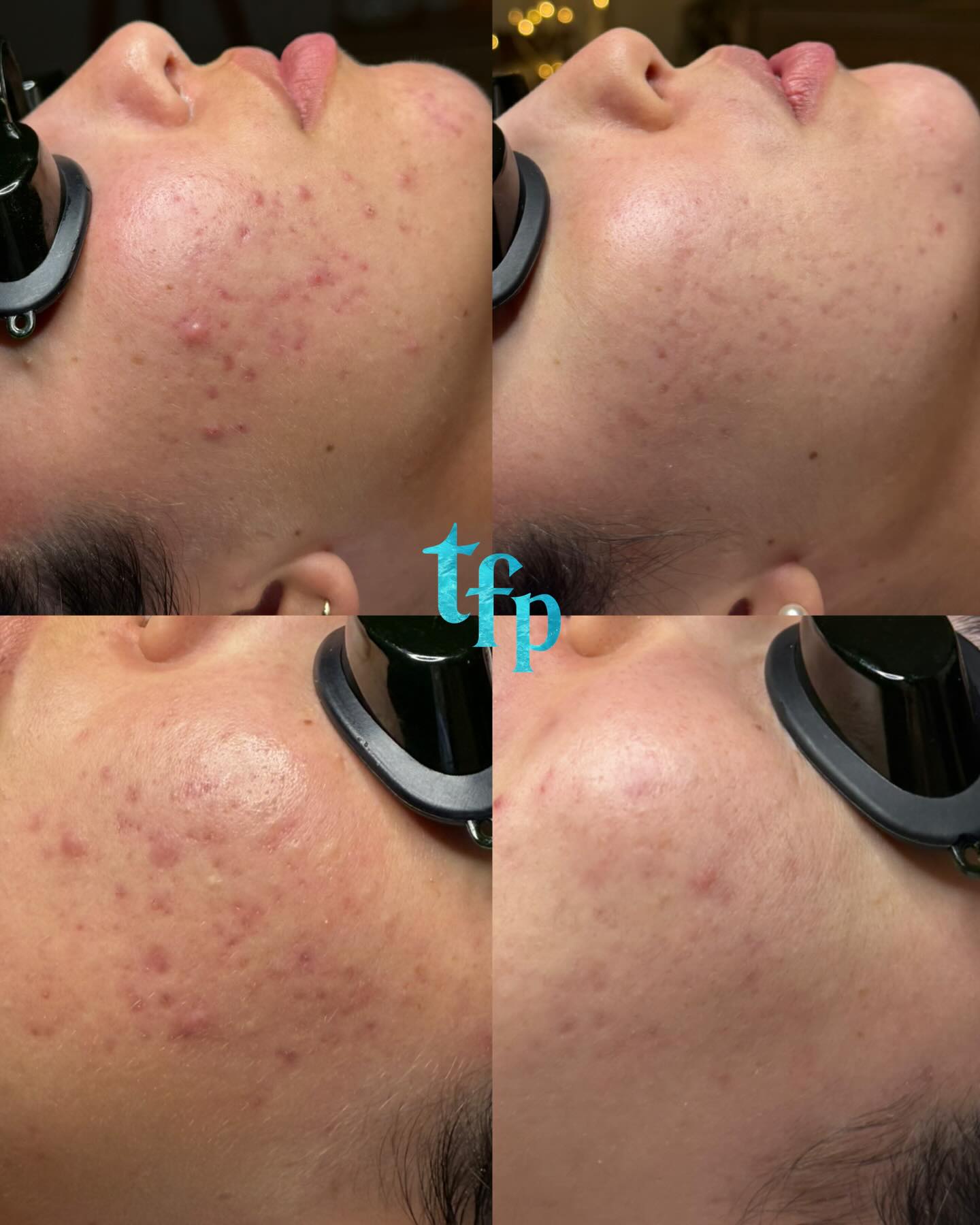Acne facial transformations always make me so happy!🤍🪼
Start clearing your acne naturally with me by booking an Acne Facial on Thefaceplacemi.com