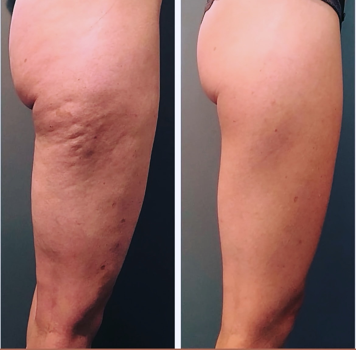 Your Summer Body… refined the IAM way ✨
Cellulite. Texture. Tone.
This is what real transformation looks like.
At Institute of Aesthetic Medicine, our IAM Summer Body Protocol is designed to sculpt, smooth, and strengthen—because confidence isn’t just about weight… it’s about quality of skin and muscle.
Think:
✨ T-Shape 2 for lymphatic drainage + fat reduction
✨ BodyTone for muscle definition + tightening
✨ GLP-1 + peptides for metabolic optimization
✨ Targeted skin tightening (PixelRF) for that luxe finish
This is not a quick fix.
This is a strategy.
Because at IAM… we don’t chase trends—
we create elevated, lasting results.
Now available in Berlin + Milton locations
📞 Call to schedule your customized consultation
#IAMSummerBody #LuxeWellness #BodyByIAM #CelluliteTreatment #SkinTightening BodyContour CoastalLuxe AgelessByDesign
