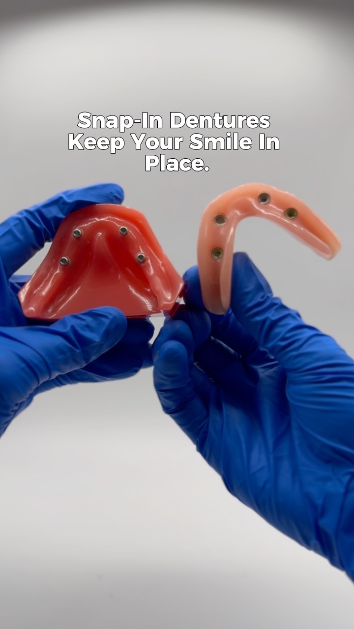 Snap-in dentures give you a secure, stable fit so you can eat, speak, and smile without second guessing it. 🦷
They attach to dental implants, which means your denture actually stays in place. No shifting. No constant adjusting. Just a smile that feels right.
And the best part? Your denture is crafted in our on-site lab, so it’s made specifically for you with comfort, precision, and speed in mind.
📞 Call 318-232-4404 to schedule your visit and get your free X-ray & exam on your first visit!
#DenturesBossierCity #SnapInDentures #DentalImplantsBossierCity #TeethInADay #CustomDentures