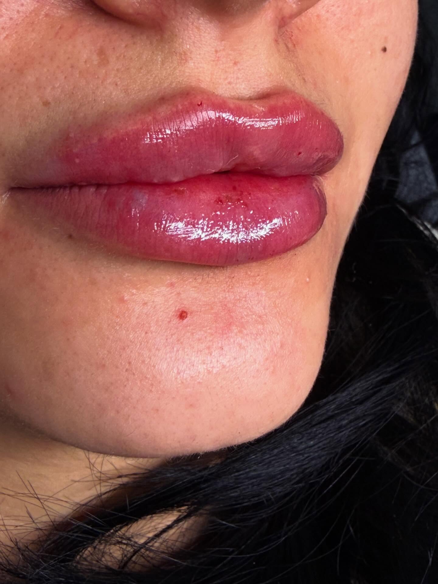 Dudak dolgusu 👄