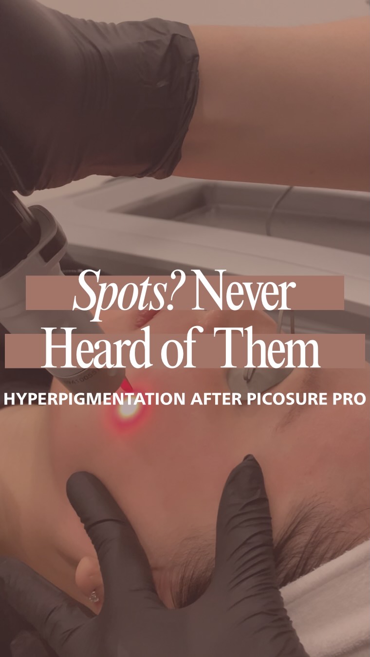 Picosure Pro works by delivering energy so fast that it doesn’t create heat. No heat = less risk of triggering more hyperpigmentation, which is why it’s a great option for skin of colour.
It’s one of the top lasers for hyperpigmentation, while also helping with skin rejuvenation. This means it helps minimize pores, smooth fine lines + wrinkles, and even out complexion.
Hyperpigmentation is cleared gradually, so multiple sessions are needed. Also, downtime is minimal. You’ll be a little pink for the day, and that’s it!
Ready to get rid of your hyperpigmentation and never see it again? (with the understanding that maintenance is key to maintain results and treat any NEW pigment 😉)
Book your Picosure Pro consultation today.
#picosurepro #lasertreatments #hyperpigmentation #wrinkles #northyorkskinclinic