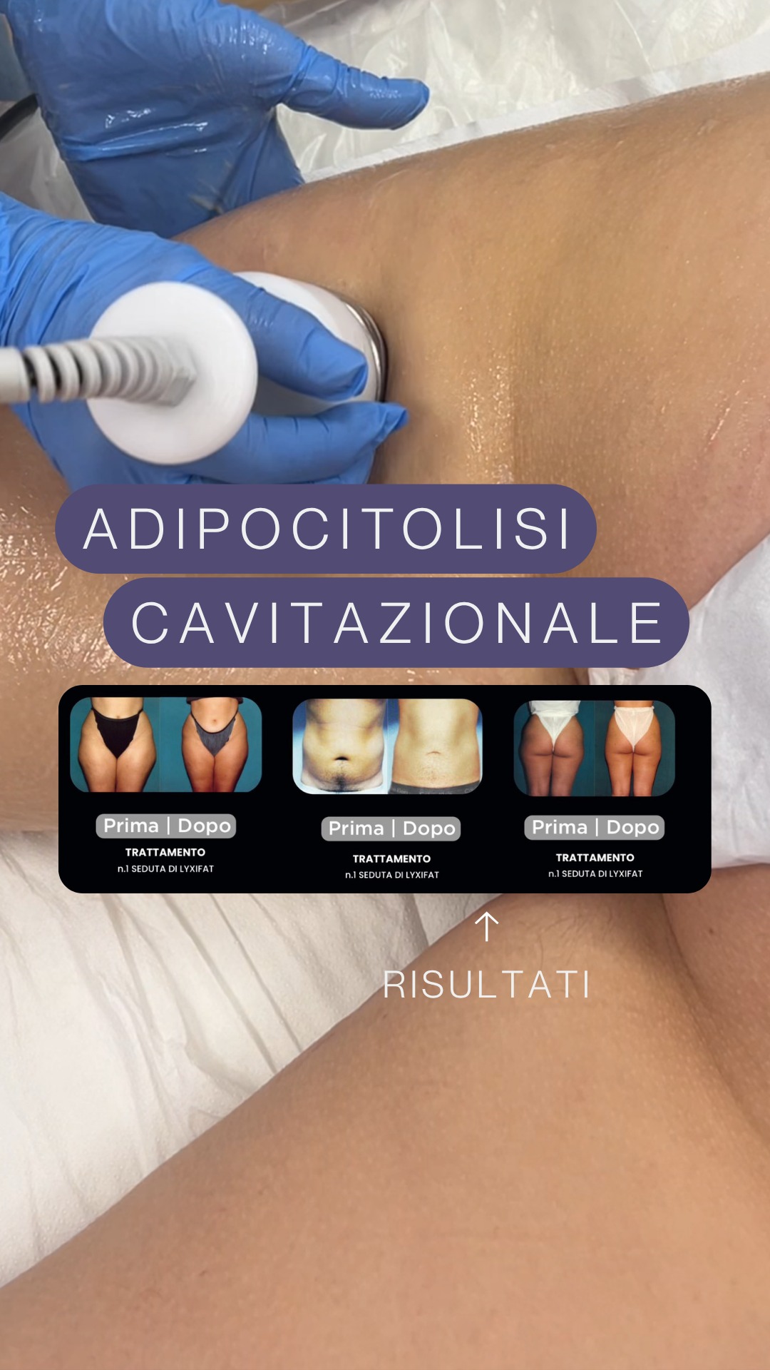 Ecco il video in cui vi facciamo vedere la seconda fase del trattamento Adipocitolisi cavitazionale!
Con il nuovo macchinario arrivato nel Centro chiamato "Lyxifat" possiamo ridurre il pannicolo adiposo già dalla prima seduta, lavorando su inestetismi come adipe in eccesso e cellulite (in vari stadi). Perché è rivoluzionario? Perché non ci sono aghi coinvolti nel processo!
Il 15 aprile, prenotandoti all'open day che abbiamo pensato per farvi scoprire al meglio questa tecnologia, potrai usufruire del trattamento ad un prezzo molto scontato. Contattaci per saperne di più ⬇️
.
.
.
Prenota il tuo appuntamento di benessere presso Centro Riabilitativo Psico Fisico di Motta di Livenza chiamandoci al 📞0422766896 o scrivendo su whatsapp al 3887974760