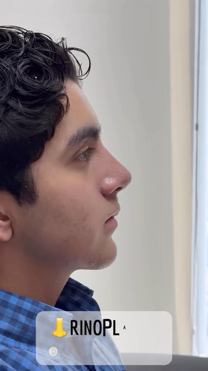 🔹 Tu satisfacción es nuestra prioridad. Cada Rinoplastia es diseñada para ti, considerando tus facciones y deseos.
🔹Evolución a un mes de Cirugía Nasal Estética y Funcional.
🔹 Gracias a mi excelente paciente por su confianza y permitir compartir su resultado.
🔹”Made by hand. Crafted with passion”
🧑⚕️ Dr. Guillermo Guerra Gil de Leyva
🏥 Hospital Ángeles Valle Oriente
📱 81-1252-0132
🎓Universidad de Monterrey
👃 Rinoplastia Estética y Funcional
🚫 No taponamiento
Cédula Profesional: 3070499
Cédula Especialista: 4503273
No. Certificación CONACEM: GUG-1748/04
Aviso de Publicidad COFEPRIS: 2419032002A00111
❕Paciente autoriza difusión de imágenes con fines académicos e informativos.
❕Los resultados finales se pudieran observar hasta un año de la cirugía y dependerá tanto del compromiso del cirujano como del paciente, así como del tipo de cirugía, tipo de piel, cuidados post-operatorios, etc.
#RinoplastiaPersonalizada #TuNarizTuEstilo
#rinoplastia #rhinoplasty #septoplastia septoplasty rinoseptumplastia rhinoseptoplasty nosejob nose nosesurgery tabiquenasal otorrinolaringologia entsurgery cirugianasal cirugiatabique cirugiaesteticanasal
belleza confianza autoestima
cosmeticsurgery
otorrinolaringologiamonterrey otorrinomonterrey beforeandafter antesydespues
estructuredrhinoplasty
rinoplastiaestructurada
rinoplastiaultrasonica
ultrasonicrhinoplasty
