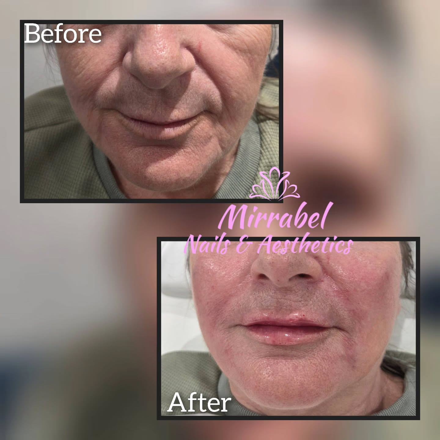 Radiant Results at Mirrabel Aesthetics! ✨
Witness the incredible transformation! Loving these refreshed and rejuvenated results for my lovely client. By focusing on restoring volume and smoothing fine lines, we’ve achieved a naturally youthful glow that highlights her best features.
At Mirrabel Aesthetics, our goal is always to enhance your natural beauty with precision and care.
#MirrabelAesthetics #BeforeAndAfter #SkinRejuvenation #NaturalResults #AestheticsClinic