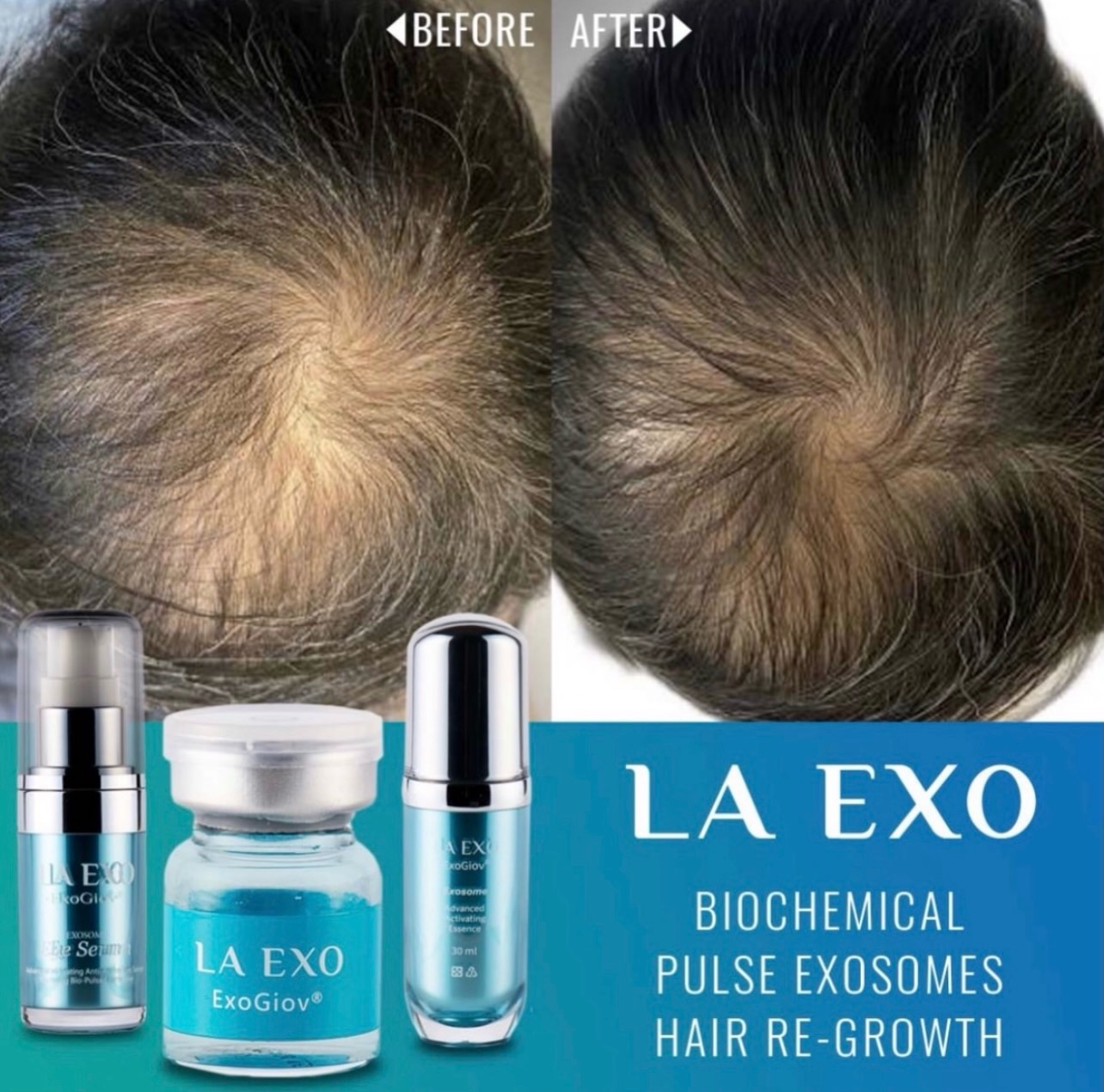 Struggling with thinning hair or hair loss? This could be the breakthrough you’ve been waiting for…
Introducing LA EXO Biochemical Pulse Exosomes – an advanced regenerative treatment designed to stimulate the scalp, awaken dormant hair follicles, and support natural hair regrowth.
This cutting-edge treatment works at a cellular level, delivering powerful growth factors and regenerative signals directly to the scalp to help restore healthier, thicker-looking hair.
✨ What can LA EXO Exosomes help with?
• Thinning hair
• Early-stage hair loss
• Weak or slow-growing hair
• Supporting follicle regeneration
• Improving scalp health and hair density
The goal? Stronger follicles, improved scalp health, and fuller-looking hair over time.
At Elite Nurse Led Aesthetics, treatments are tailored to your individual hair concerns to help you achieve the best possible results.
📍 Wakefield
📩 DM us to book your consultation or to find out if this treatment is right for you.
#HairRegrowthWakefield #ExosomeHairTherapy #HairLossSolutions #EliteNurseLedAesthetics #HairRestorationUK