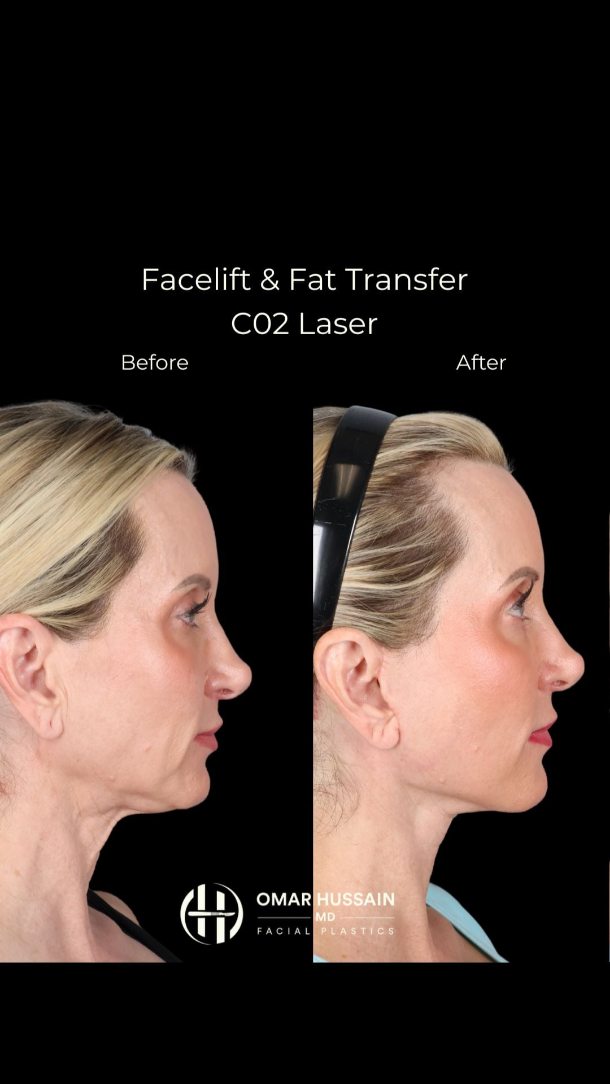 A subtle lift. A natural refresh.
After a Facelift & Fat Transfer, this result highlights how precise, thoughtful changes can restore a more youthful, well-rested appearance—without ever looking overdone.
#facelift #NeckLift #FatTransfer #facialrejuvenation #beverlyhillsplasticsurgeon