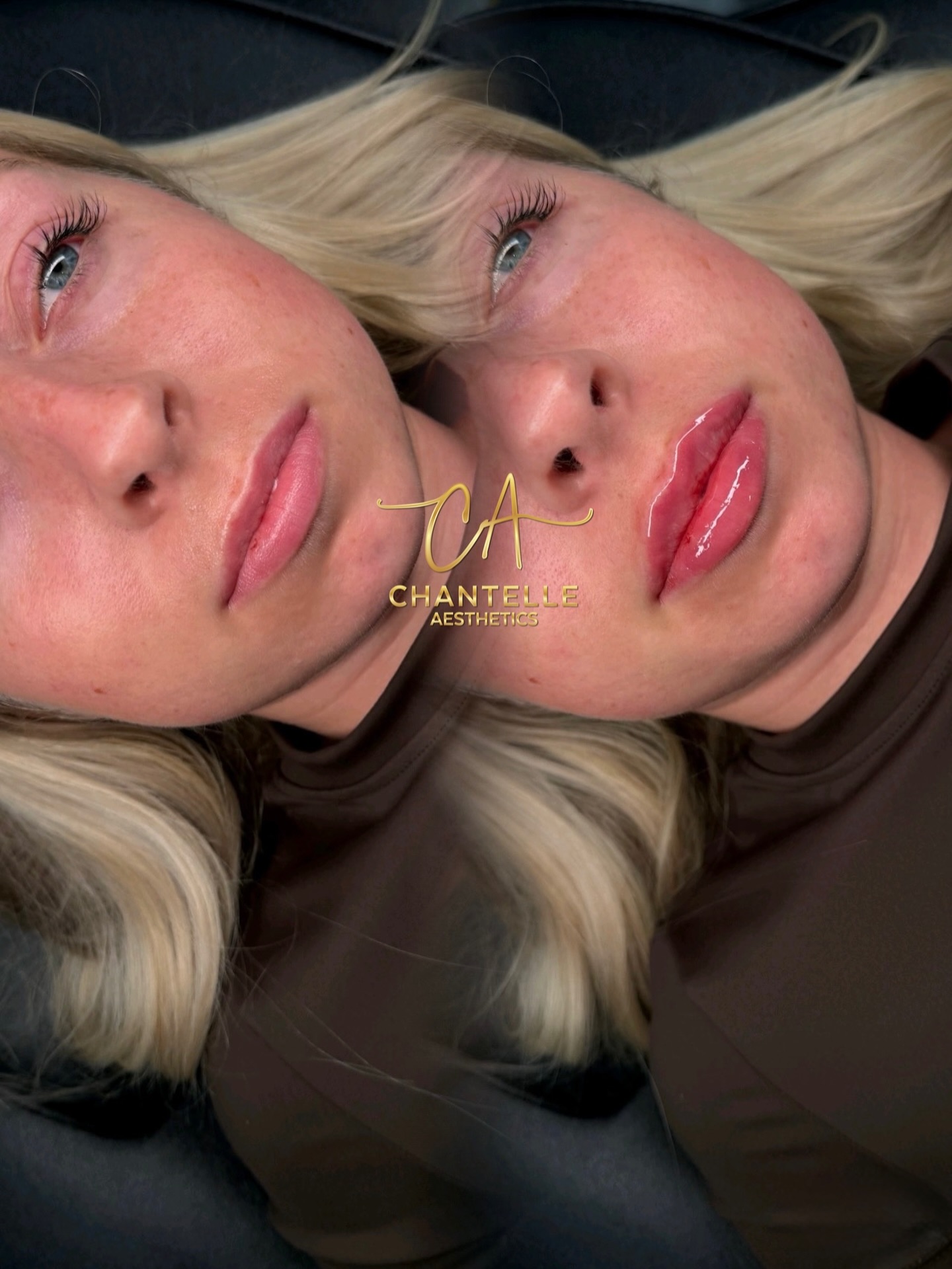 Your lips but better 😮💨 0.8ml to give definition, lift and shape whilst still keeping your lips looking natural! How pretty are these 😍