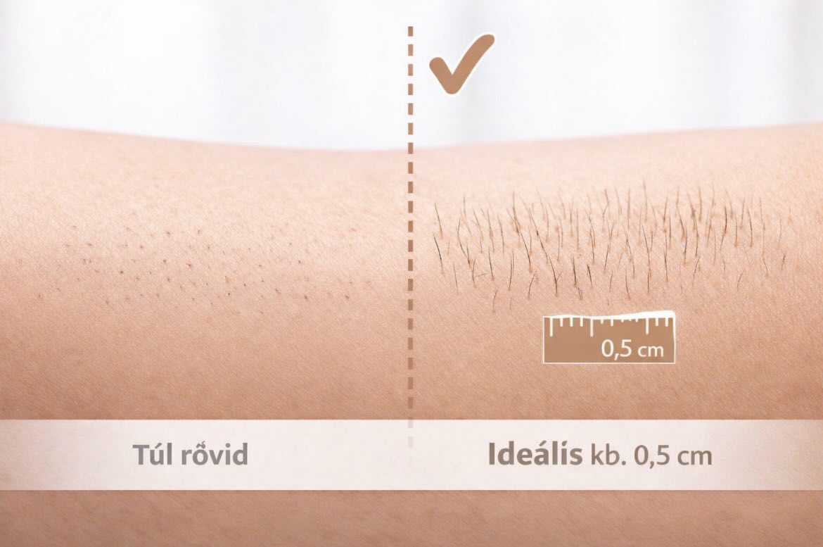 ✨ Így készülj a waxolásra ✨
💡 A megfelelő szőrhossz kulcsfontosságú!
Az ideális hossz kb. 0,5 cm ezt borotválástól számítva általában 10–12 nap alatt éri el a szőr. Ebben az állapotban a szőrszálak már elég hosszúak ahhoz, hogy a wax megfelelően „ráfogjon”, és egy mozdulattal, a gyökerükkel együtt távolíthatók el.
Ha a szőr túl rövid:
– nem tapad bele elég stabilan a waxba
– könnyebben elszakad, nem a gyökérrel együtt jön ki
– gyorsabban visszanő
– maradhatnak vissza szálak, egyenetlen lehet az eredmény
– ugyanazt a területet többször kell kezelni, ami jobban irritálhatja a bőrt
– és igen… kellemetlenebb is lehet 😣
💖 Ha kivárod a megfelelő hosszt, a kezelés kíméletesebb, gyorsabb és sokkal tartósabb eredményt ad.
Ha bizonytalan vagy, nyugodtan írj nekünk segítünk 🤍
#waxolás #szőrtelenítés #szépségápolás #újvendég #szalontippek