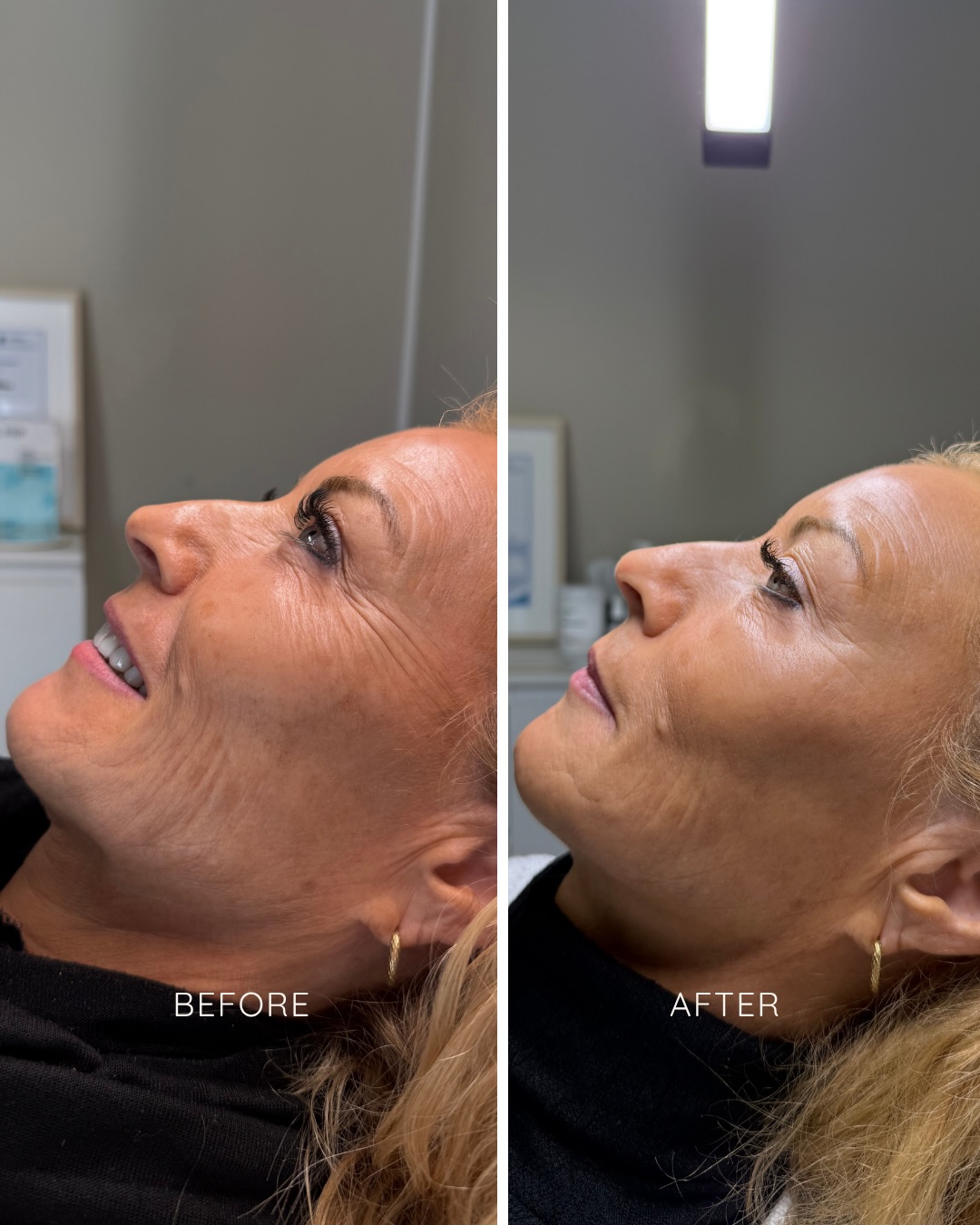 Before & After einer Kombination aus Botulinumtoxin bei den Krähenfüssen und Profhilo im unteren Gesichtsbereich.
Während Botulinumtoxin die Muskulatur sanft entspannt und feine Linien glättet, versorgt Profhilo die Haut intensiv mit Feuchtigkeit und unterstützt die Kollagenproduktion. Ideal bei Trockenheitsfältchen oder wenn die Haut an Frische und Glow verloren hat. 🌟
Das Ergebnis entwickelt sich schrittweise – zu sehen ist hier der Zustand 14 Tage nach der ersten Behandlung. Für ein optimales Resultat sind zwei Sitzungen mit Profhilo notwendig.
Du möchtest wissen, ob diese Kombination für dich geeignet ist?
Wir beraten dich gerne persönlich.
#nuaaesthetics #profilho #botulinumtoxin #glow #beforeandafters