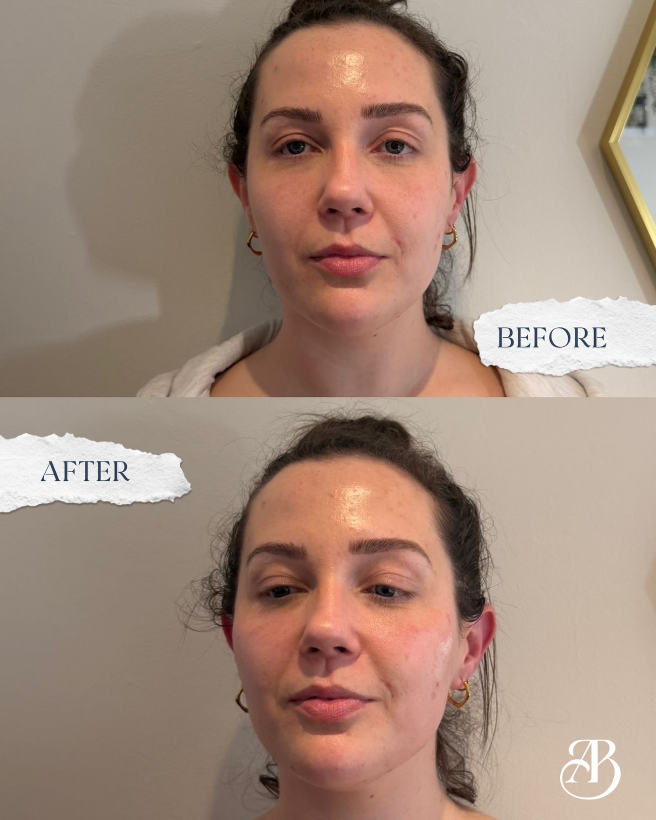 Looking for that subtle lift? ✨
1ml of our beautiful Teoxane fillers can make all of the difference.
We enhanced our clients natural beauty with subtle volume to create more defined cheeks, a more sculpted jawline and a beautifully balanced face structure 🤍
The results? It’s always precision over volume. Lifted, sculpted and still completely her, and the client loves her cheeks too! 😍
DM us or book your consultation today! 💌
📍Oldswinford, Stourbridge
#aesthetics #filler #cheeks #structure #skincare