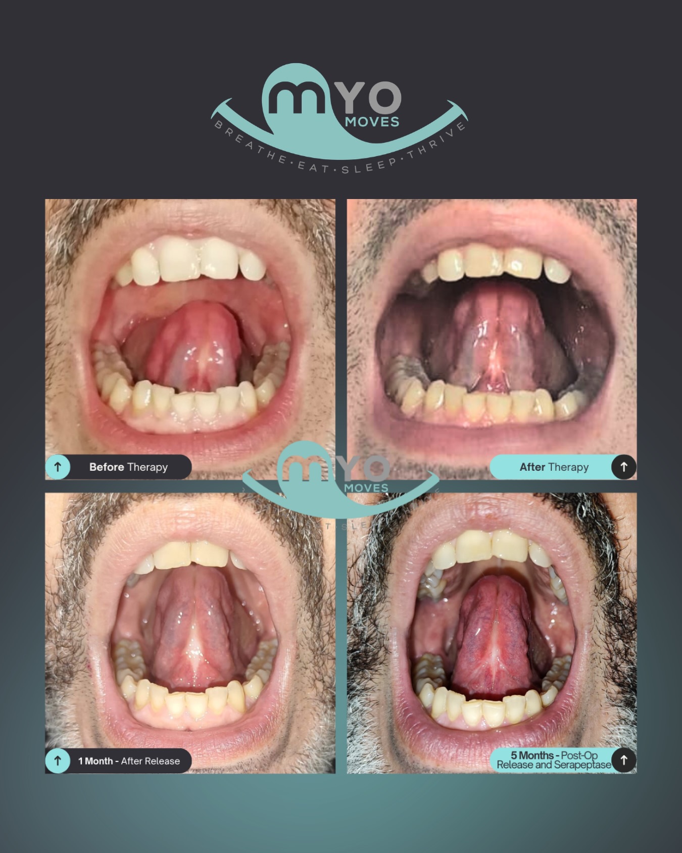 A tongue tie release is just the beginning. What happens during recovery? That’s what creates the real change.
Here’s what 5 months of intentional work looks like:
Top left: Limited elevation, you can see restriction through the midline. The floor of the mouth is doing a lot of the lifting, and the tongue can’t quite reach or hold where it needs to be.
Top right (with therapy): Better lift, less reliance on the floor of the mouth. You’re starting to see better organization and early coordination.
Bottom left (1 month post-release): Mobility improves a lot, but scar tissue is forming along the midline. It looks thicker and a bit restricted.
Bottom right (5 months post-op + therapy): The midline is smoother and elevation is controlled and coordinated. This is what consistent myofunctional therapy and healing support (like serrapeptase) can do - less scar tissue, better tissue quality, and stronger functional patterns after release.
The process: Mobility → healing → remodeling → coordination → function.
The release creates the opportunity, what you do after determines the outcome. Ready to support your airway? Comment MYO to learn more! 💬
#myofunctionaltherapy #myo #airwayhealth #tonguetie #tonguetierelease