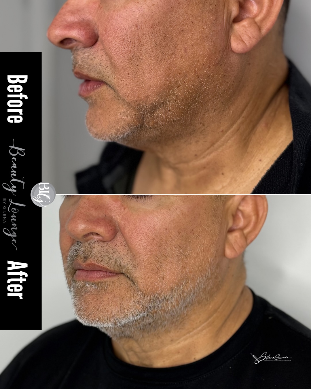 🚨 STOP SCROLLING… ⚠️ Si tienes papada… esto te interesa.…
💥 mandíbula definida
💥 piel más firme
💥 bye bye flacidez
Y no… NO es cirugía 😮💨
Esto es Endolift
ciencia + precisión + experiencia 🪄
💬 Comenta “JAWLINE” si quieres verte así
📲 DM para tu evaluación GRATIS
📍 Miami | Hallandale
⸻
#Endolift #JawlineTransformation #SinCirugia #BeforeAfter