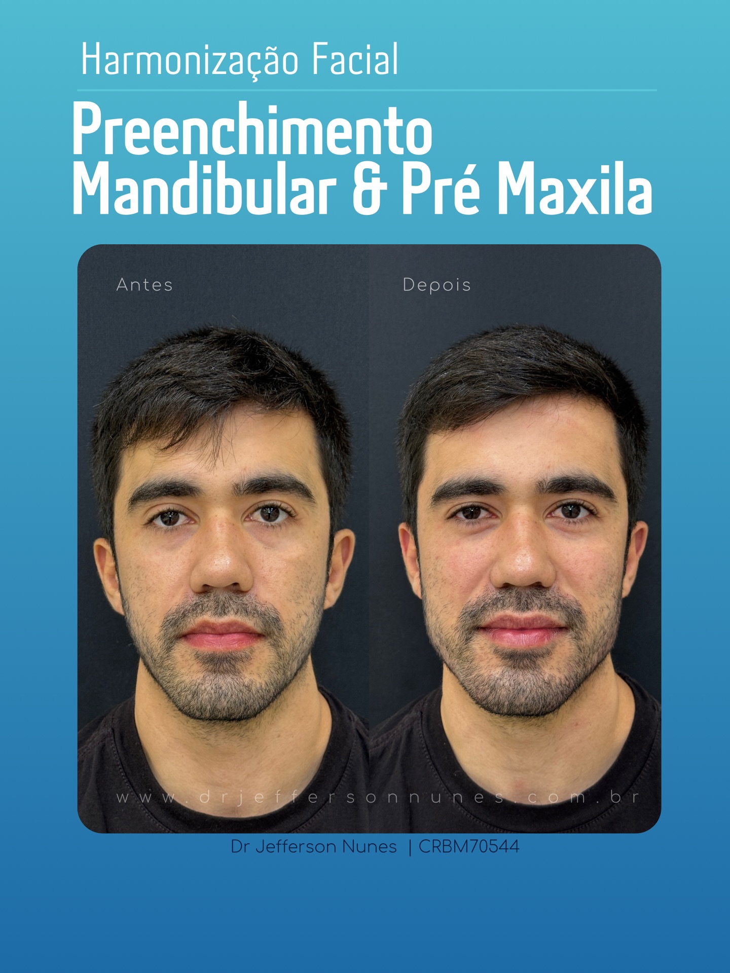 Estrutura, definição e equilíbrio facial.
O preenchimento de mandíbula associado à pré-maxila promove sustentação dos tecidos, melhora o contorno facial e valoriza a harmonia entre os terços da face. O resultado é um perfil mais definido, com naturalidade e sem exageros.
Planejamento individualizado, técnica precisa e foco em resultados seguros.
Dr. Jefferson Nunes | Harmonização Facial e Corporal.
Cirurgião-Dentista | Especialista em Harmonização Orofacial | CRO-SP 138207
Biomédico Esteta | Especialista em Estética | CRBM 70544
#preenchimentofacial #mandibula #harmonizacaofacial #esteticaavancada #contornofacial