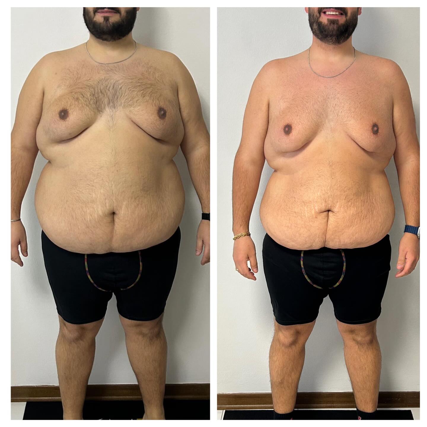 ⚠️⚠️⚠️ work in progress!
Oggi vi mostro questo cambiamento che può servire davvero da incoraggiamento per chi si trova in una situazione di salute molto compromessa.
Poco più di un anno fa si presentava in studio da me con uno stato di obesità di 3 grado avanzato, una circonferenza di addome di 2 metri!
Ad oggi è vicino al raggiungimento dell’obesità di1 grado che è vero è ancora una situazione di salute complessa ma non come prima.
Ha perso 34 kg e ben 70 cm di circonferenza di addome.
Ha saputo reagire ad un periodo difficile dove molti magari avrebbero abbandonato. E invece si è ripreso e piano piano si sta riprendendo in mano la sua vita.
Permettermi di dirlo: senza farmaci, senza chetogeniche, digiuni o altre metodiche particolari.
Ci vuole testa? Si!
Ci vuole amore per la vita? Si!
Complimenti e avanti così 💪💪💪💪
#work #cambiamento #vivere #salute #nutrizione