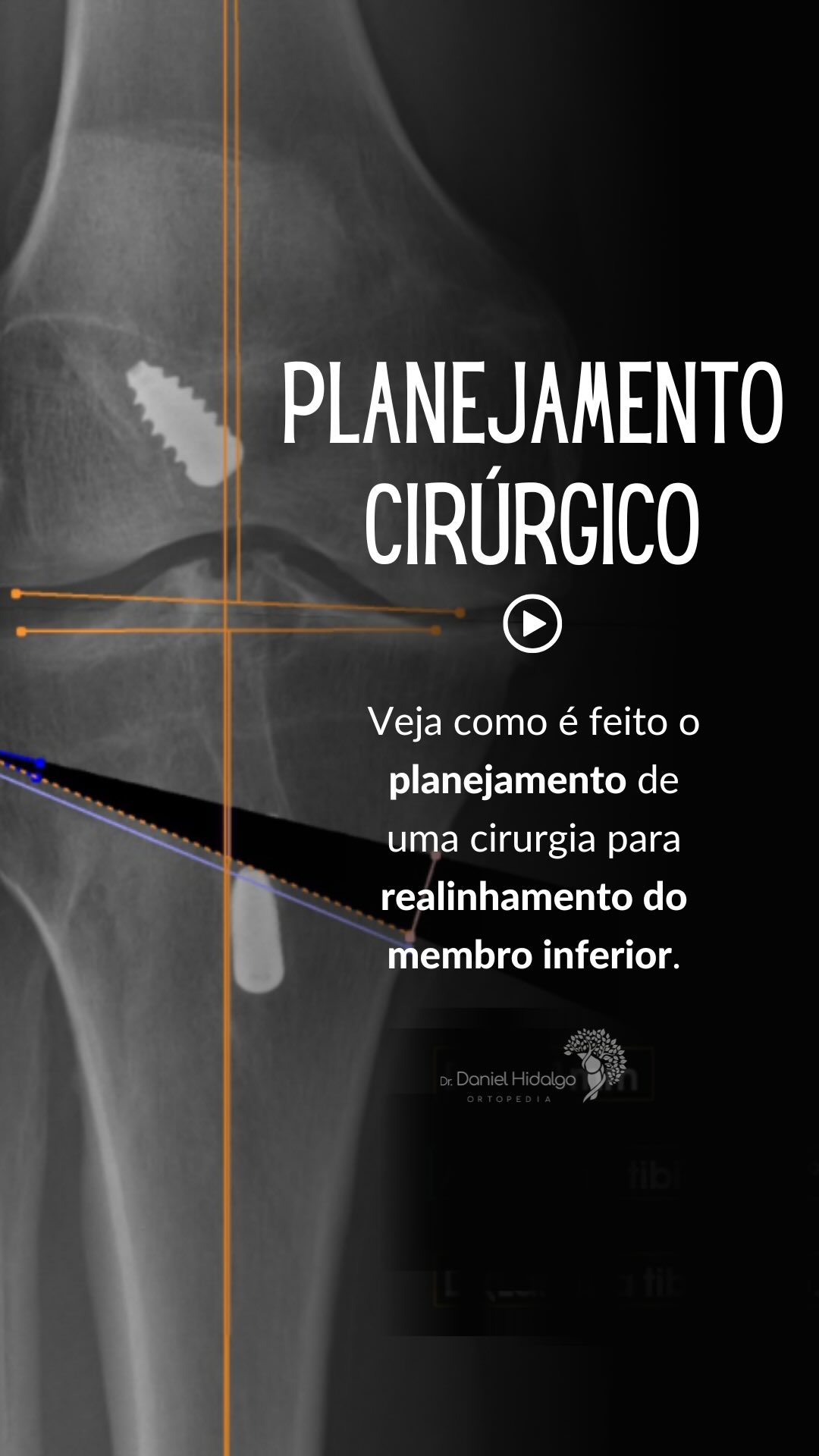 Planejar é tão importante quanto executar. 🦵✨
Na cirurgia ortopédica, cada detalhe faz diferença no resultado final, especialmente em procedimentos como a osteotomia. No vídeo, mostro como utilizo o planejamento digital com o PeekMed para analisar alinhamento, definir o grau de correção e prever o resultado antes mesmo de entrar no centro cirúrgico.
Esse tipo de tecnologia traz mais precisão, segurança e previsibilidade para o procedimento, beneficiando diretamente o paciente.
Dr. Daniel Hidalgo - Médico Ortopedista
CRM-SP 137.057 | RQE 41.112
Membro da Sociedade Brasileira de Ortopedia e Traumatologia (SBOT)
Membro da Sociedade Brasileira de Cirurgia do Joelho (SBCJ)
Membro da Sociedade Médica Brasileira de Tratamento por Ondas de Choque (SMBTOC)
#Ortopedia #cirurgiadojoelho#PlanejamentoCirurgico #PeekMed #qualidadedevida