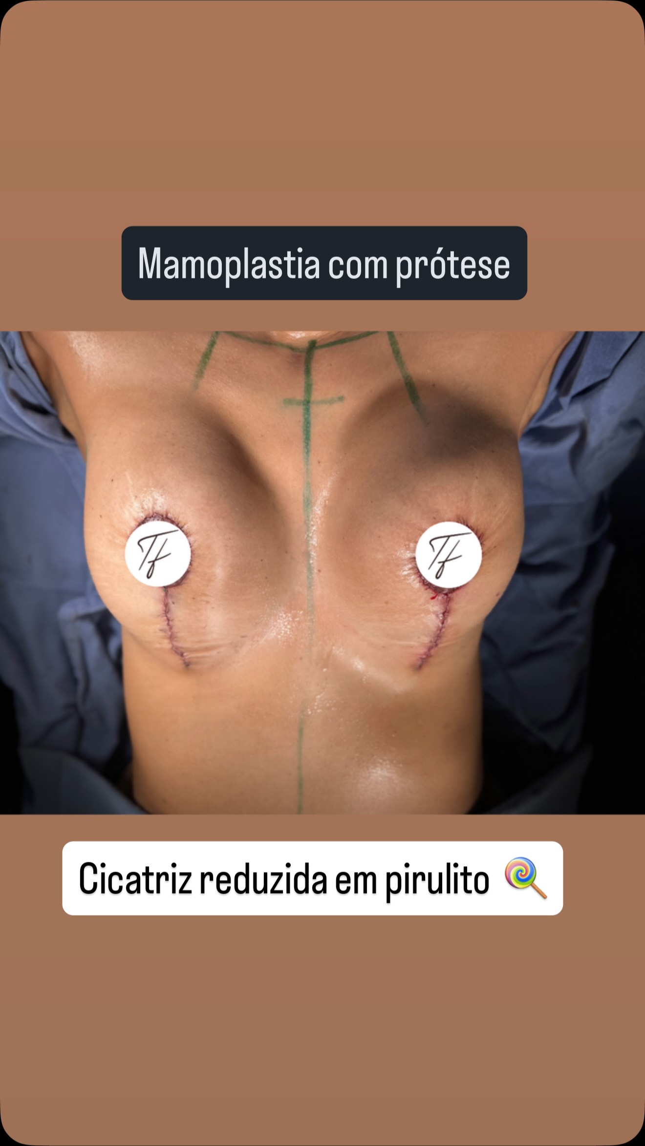 Esse não é um caso raro de ptose mamária.
Essa é uma queixa muito frequente após a gestação e a perda de peso, quando a mama perde sustentação, firmeza e formato.
Além da flacidez, existe um impacto importante na autoestima e na forma como a mulher se percebe.
A suspensão mamária, com ou sem prótese, é capaz de restaurar essa harmonia.
Neste caso, optamos pelo uso da prótese para oferecer maior firmeza, melhor projeção e um contorno mais arredondado das mamas.
O grande diferencial foi alcançar esse resultado utilizando uma cicatriz reduzida, no padrão vertical, a chamada cicatriz em pirulito.
Essa estratégia permite excelente remodelação mamária, com uma cicatriz discreta e facilmente coberta por roupas ou biquíni.
O resultado é uma mama mais firme, harmônica e com aspecto natural, devolvendo confiança, feminilidade e bem-estar.