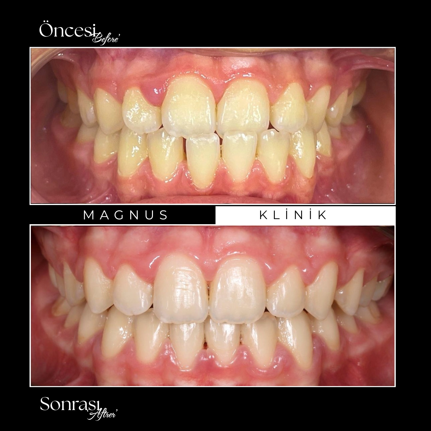 🔹Uzm.Dt @isikortodonti eşliğinde Ön dişlerde çapraz kapanışı olan hastamızda sabit tel tedavisi uyguladık. Bir sene süren tedavi ile güzel bir kapanış elde ettik ✨
#ortodontitedavisi #teltedavisi #izmirortodonti #izmirortodontiuzmanı
İlk fotoğrafların çekildiği tarih: 12.10.2024
Son fotoğrafların çekildiği tarih: 12.11.2025
* Paylaşılan görüntüler, kliniğimizde tedavi gören hastaların açık rızası alınarak yayımlanmıştır.
* Her cerrahi veya girişimsel işlemde sonuçlar kişiden kişiye değişiklik gösterebilir. İşlem öncesinde hekimimizden detaylı görüş almanız önerilir.