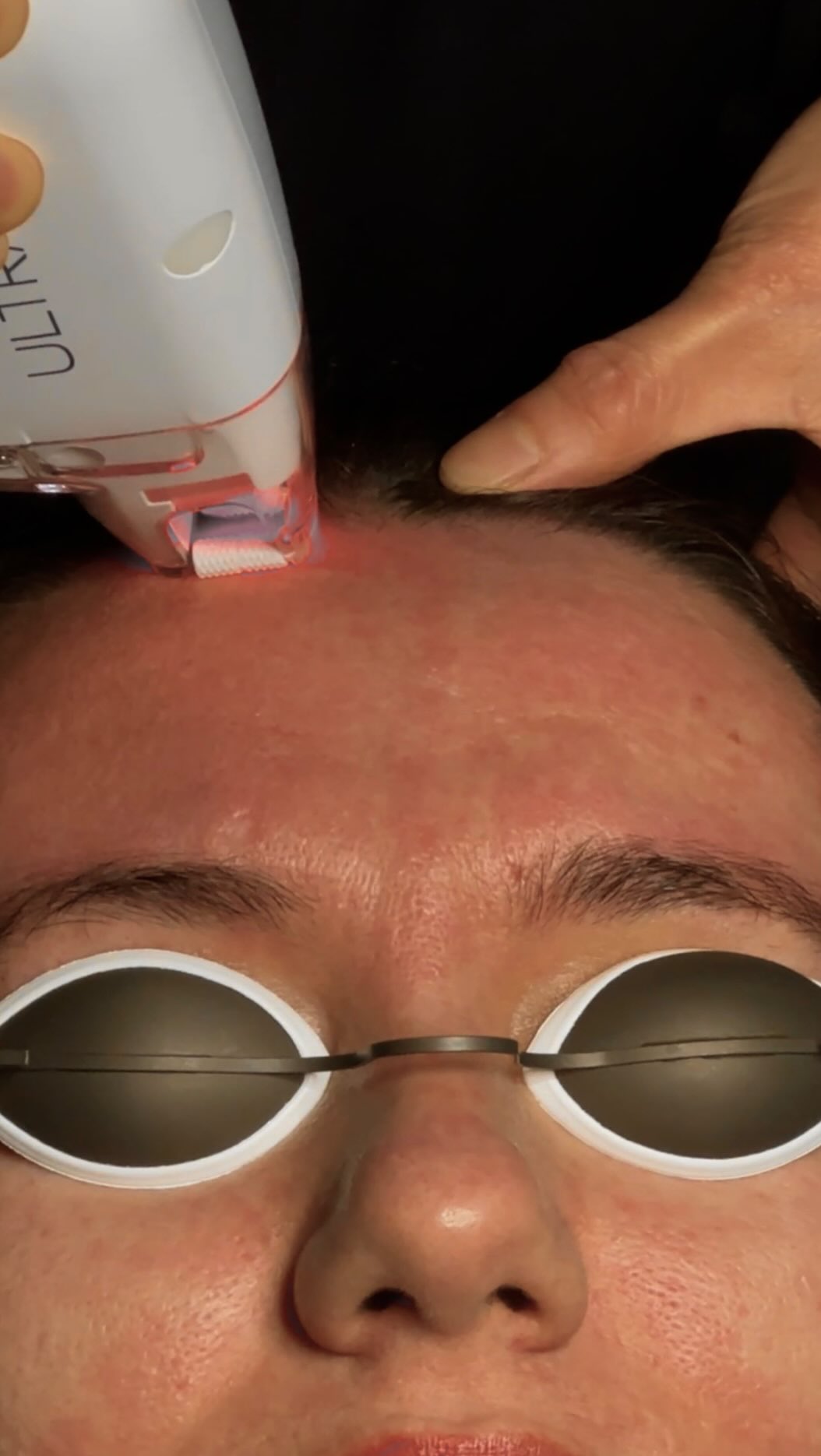 LaseMD Ultra doing its magic 🪄 the all-in-one facial laser for pigmentation, texture, wrinkles and safe for all skin types. Book at lingspa.com #lasemdultra #laser #nyc #pigmentation #lingspa