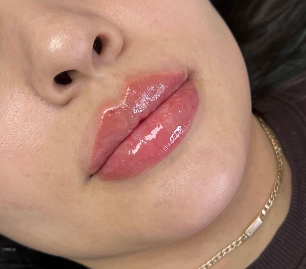 No caption needed 💋 #aestheticsbyam #oxforduniversity #oxfordlipfillers