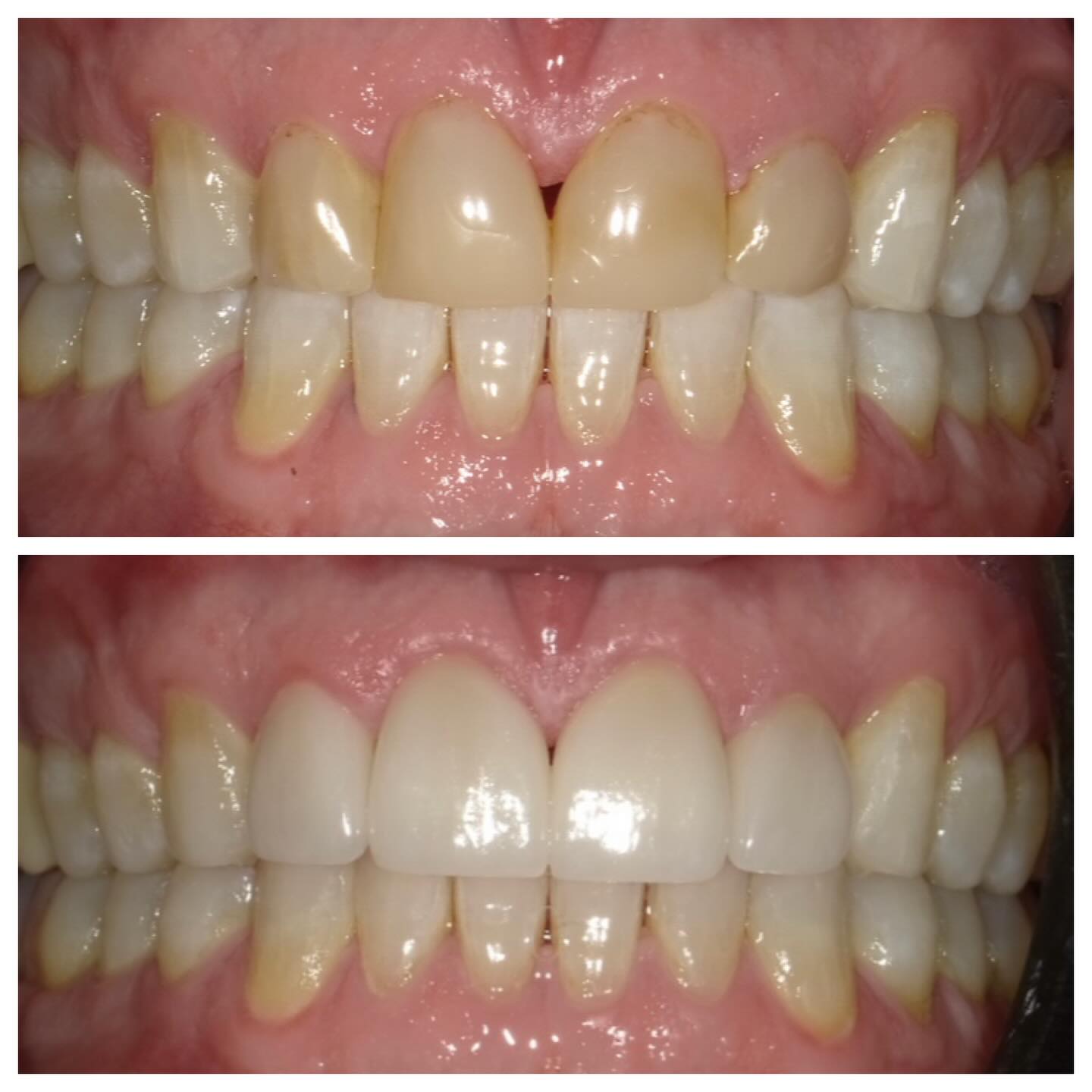 ✨ Smile refresh, done right ✨
This patient came to me with composite veneers that were placed over a decade ago. While they had served him well, the color and shape no longer matched his natural smile or the look he wanted today.
We started with Invisalign to properly align the teeth (because great veneers always start with great positioning 👏), followed by a gentle whitening phase to brighten his natural tooth color.
Once we had the ideal foundation, I replaced his old composites with new veneers, focusing on softer contours, better proportions, and a more natural luminous shade.
The result? A cleaner, brighter, and more balanced smile that still looks like him… just refreshed ✨
Subtle changes. Big impact.
#SmileMakeover #CompositeVeneers #Invisalign##CosmeticDentistry NaturalResults BeforeAndAfter