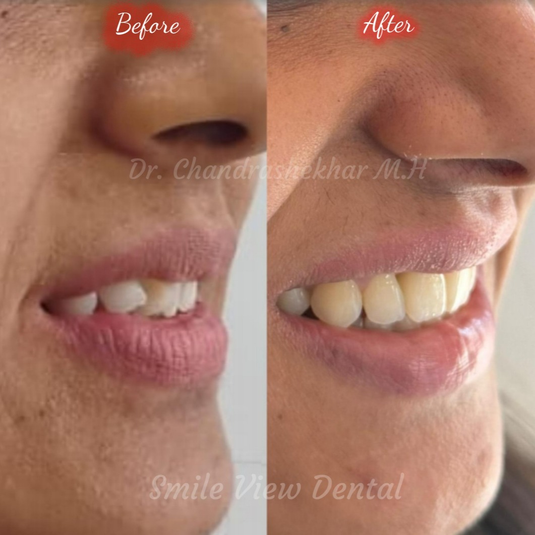 Smile Transformation Story ✨
A confident smile can change everything!
This case involved an upper central incisor (front tooth) that was rotated nearly 180 degrees. With precise orthodontic treatment and expert care, we successfully corrected the alignment and completely transformed her smile.
The result?
A natural, beautiful smile that not only looks great but also boosts confidence.
Every smile has a story, and we’re here to make it a happy one 😊
📍 Visit us to start your smile transformation journey today!
📍 Smile View Dental
Kanakapura Main Road, Bengaluru
🌐 www.smileviewdental.in
📞 97405 83714
#SmileViewDental #Orthodontics #BracesTreatment #SmileTransformation #HealthySmile #BangaloreDentist #Orthodontist #DentalCare #StraightTeeth #ConfidentSmile