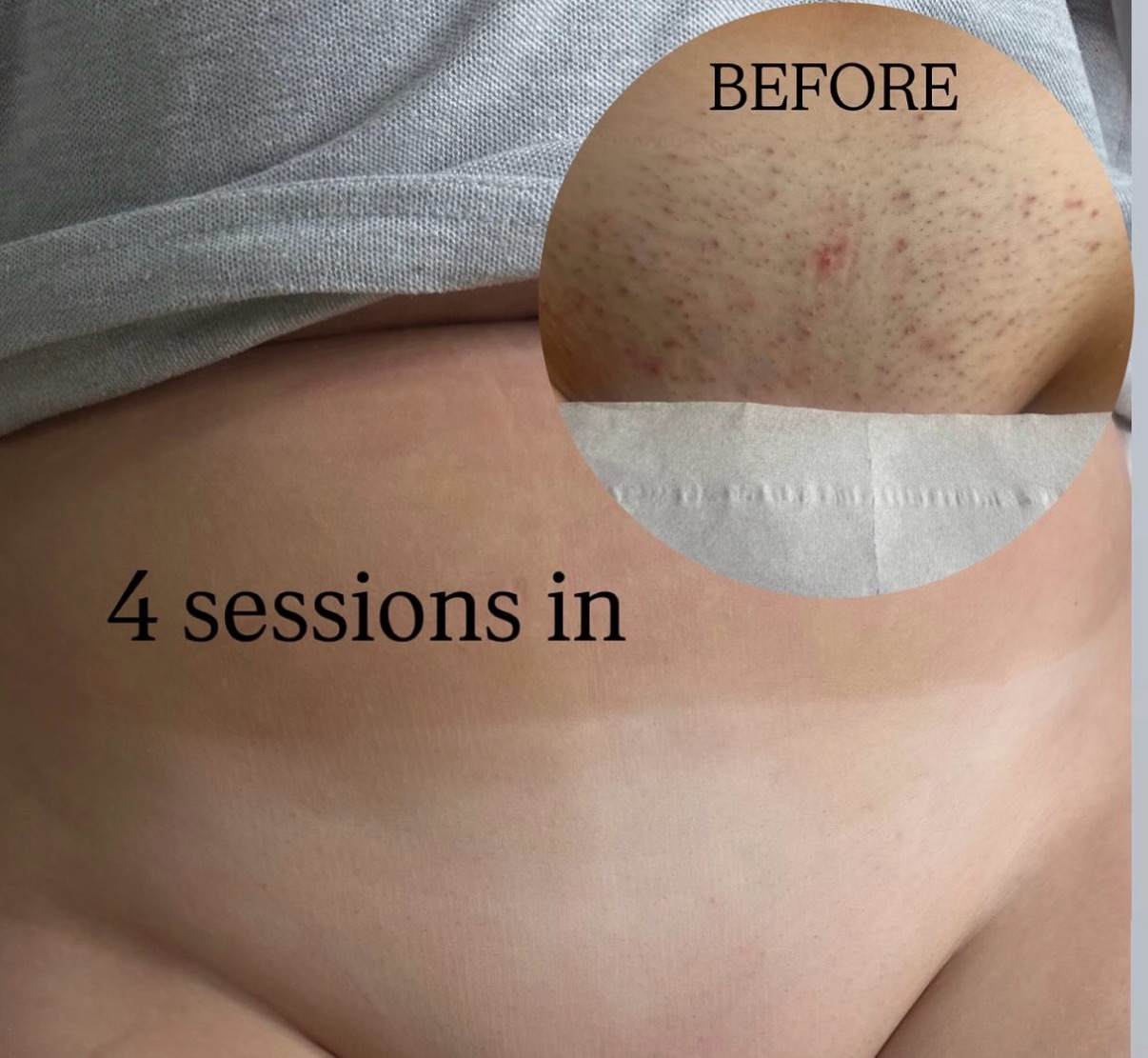 The proof is in the pudding ⚡️
(And in my “reviews” highlights 👋)
𝐁𝐄𝐅𝐎𝐑𝐄 -
Client was shaving daily
Suffering with shaving rash & ingrown hairs
Stubble was constantly present
𝟒 𝐒𝐄𝐒𝐒𝐈𝐎𝐍𝐒 𝐈𝐍 -
Client goes weeks without shaving
Shaving rash & irritation completely gone
Area feels smooth for weeks
Any hair growth is sparse, thin & wispy
Another few sessions & this client will be COMPLETE 🪄
& Ready to move to once a year top ups! ⚡️
Her life changed as soon as her very first laser session 🐬
Want results like these?
Choose HB for your Laser Hair Removal.
DM @hbskinandlaserx
Text 07946840526
Or book on Fresha
🐬⚡️🐬⚡️🐬⚡️🐬⚡️🐬⚡️🐬⚡️