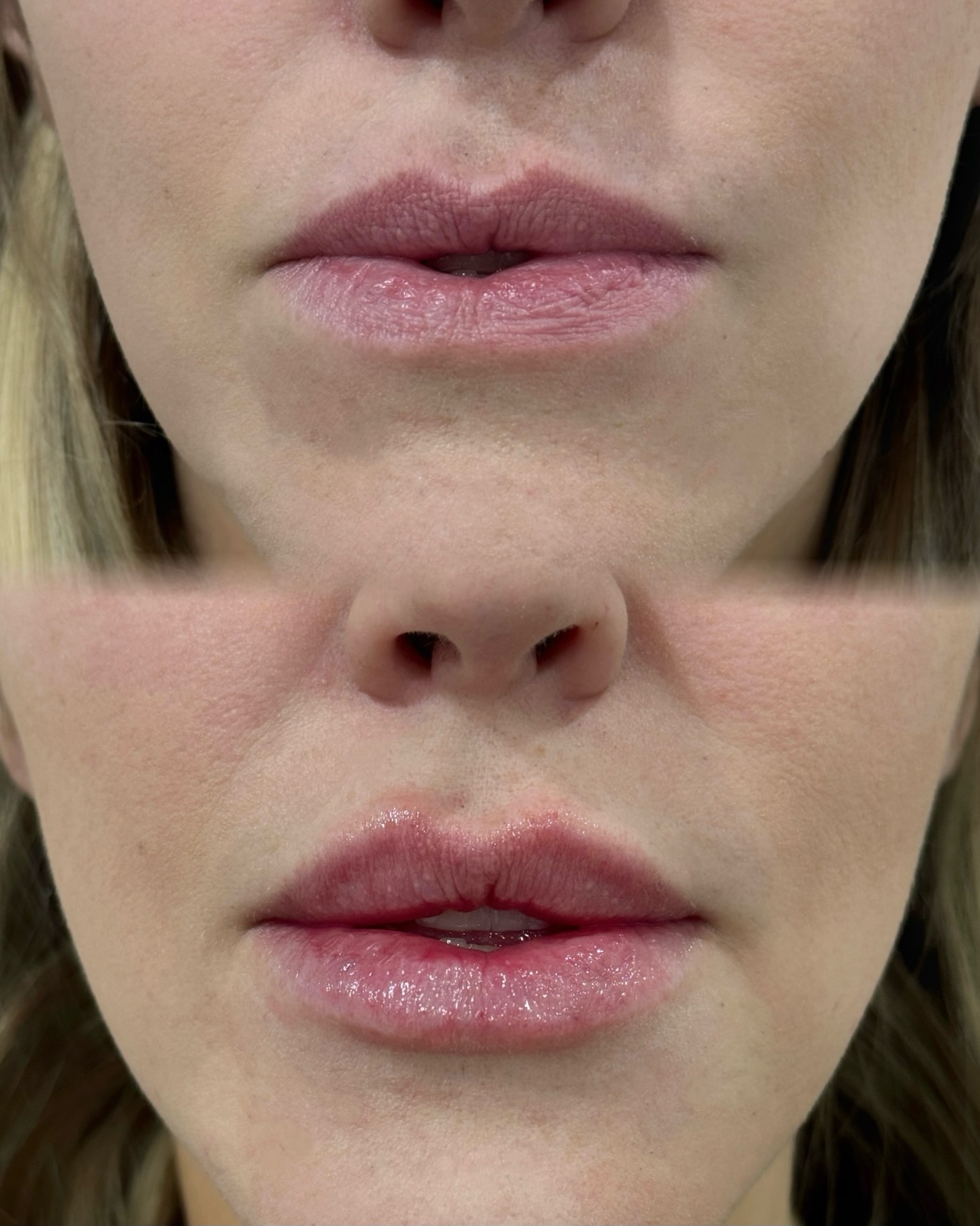 Treatment: Lip Filler Treatment using Hyaluronic Acid
For more information or to book a consultation, contact us:
📱 343-451-7141
✉️ infoshaybloo@gmail.com
Video and photos were taken immediately after treatment. Redness and swelling are normal and will subside within a few days, with final results visible in about two weeks. Please note that lighting, angles, and skin tone can vary slightly in photos, but the focus is on the progress achieved.
#filler #ottawa #nurseinjectorottawa #toronto #lips