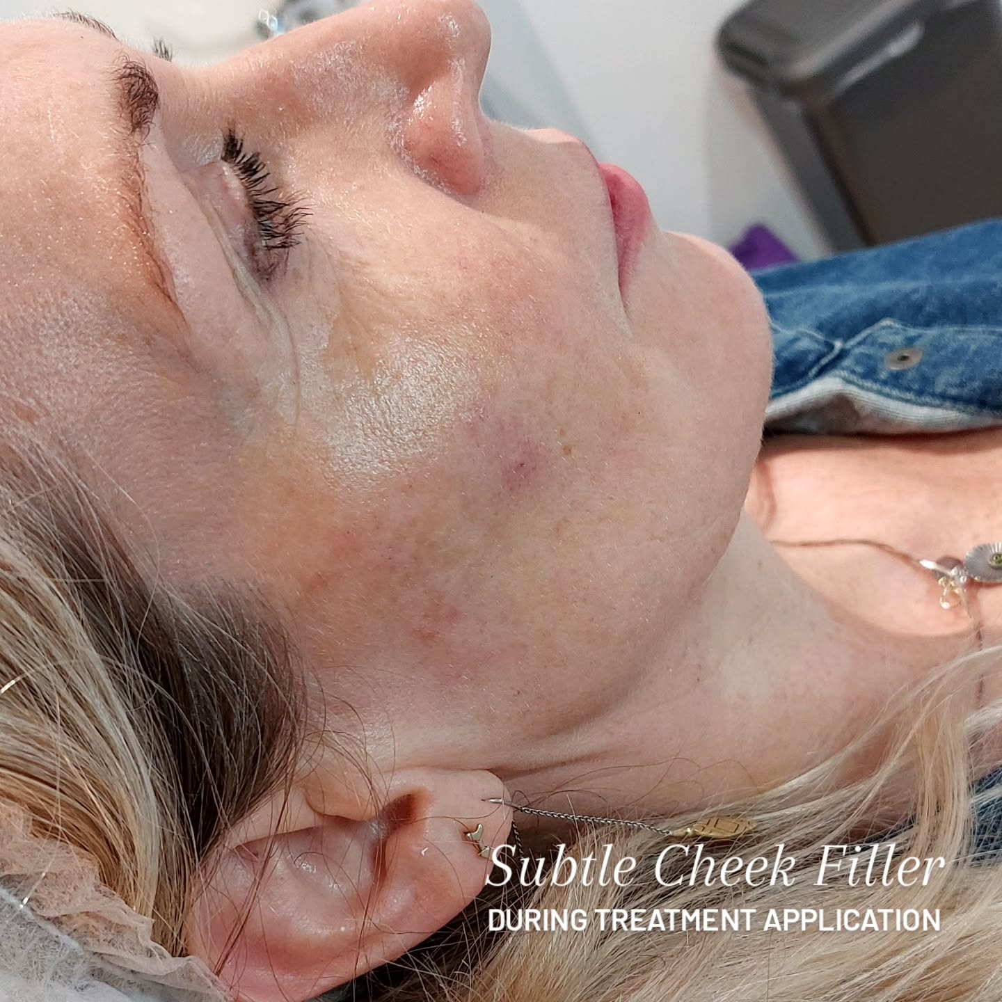 Just finished a fantastic session of cheek filler on a client! ✨ It's amazing how a subtle enhancement can make such a difference, giving that desired volume boost. The best part? Minimal downtime means they can get back to their busy lives super quickly. I love seeing their confidence shine through after the treatment! It’s all about enhancing natural beauty.💖 #CheekFiller #AestheticEnhancement #SubtleResults #NaturalBeauty #ConfidenceBoost bristol