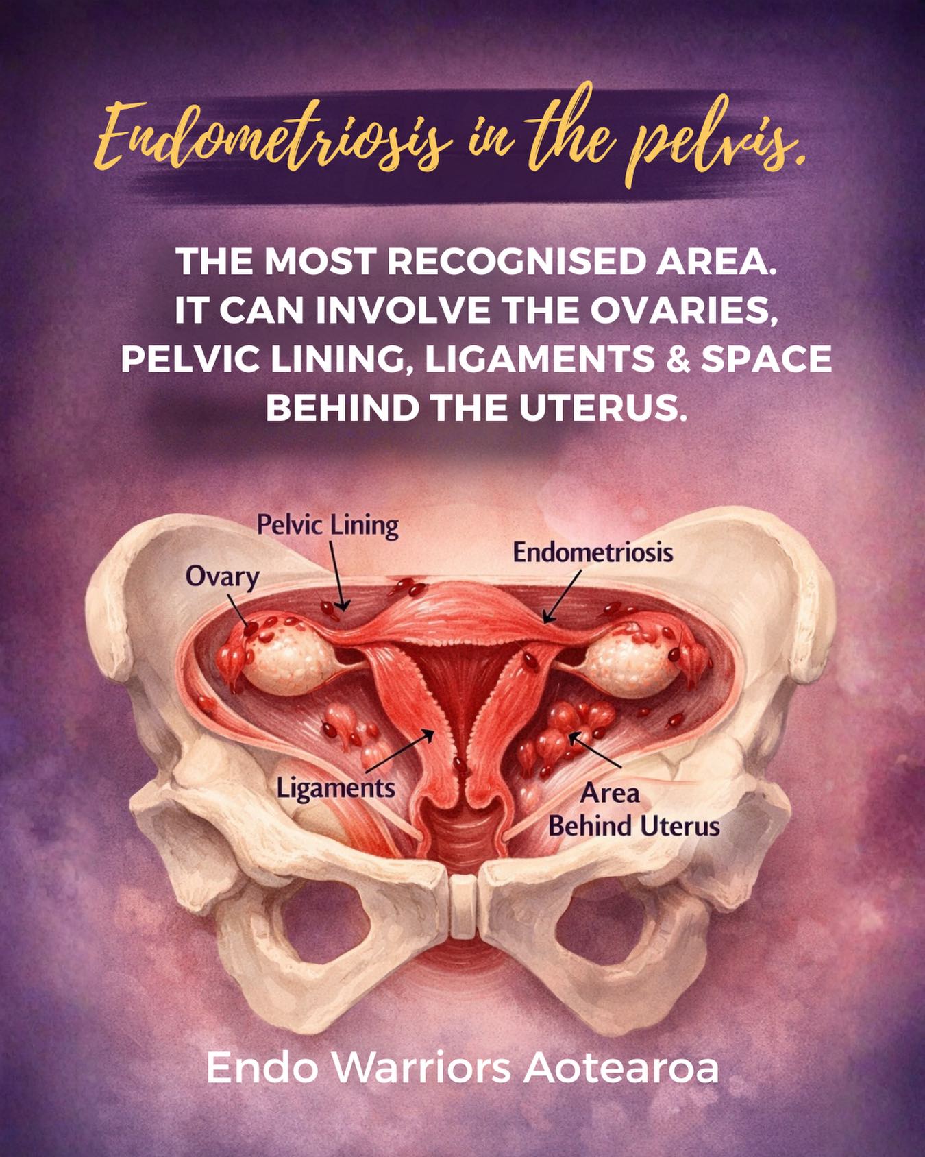 Endometriosis is most commonly found in the pelvis. But âcommonâ does not mean simple.
And it does not mean mild.
It can grow on the ovaries.
The pelvic lining.
The ligaments.
The space behind the uterus.
This is not just where pain happens.
This is where organs can become inflamed, irritated, and in some cases stuck together.
Pain here is not always cramps.
It can feel deep.
Heavy.
Pulling.
Sharp.
Constant.
Pain with movement.
Pain with sex.
Pain that does not stop when the period ends.
This is why calling it âjust period painâ is not only wrong, it is harmful.
Endometriosis is a chronic inflammatory condition. And even in the pelvis, it can affect multiple systems in the body.
If your pain has been dismissed, minimised, or normalised, that does not make it normal.
It means it has not been taken seriously.
What you can do
Track your symptoms and when they happen. Patterns matter.
Be clear about your top symptoms and how they impact your daily life.
Ask your doctor:
Could this be endometriosis?
What are my options for investigation or referral?
Is specialist imaging or a gynaecology referral appropriate?
If something does not feel right, it is okay to ask questions again or seek a second opinion.
You deserve to be listened to.
You deserve proper care.
#endometriosis #endometriosisawareness #chronicillness #endowarriors #pelvicpain