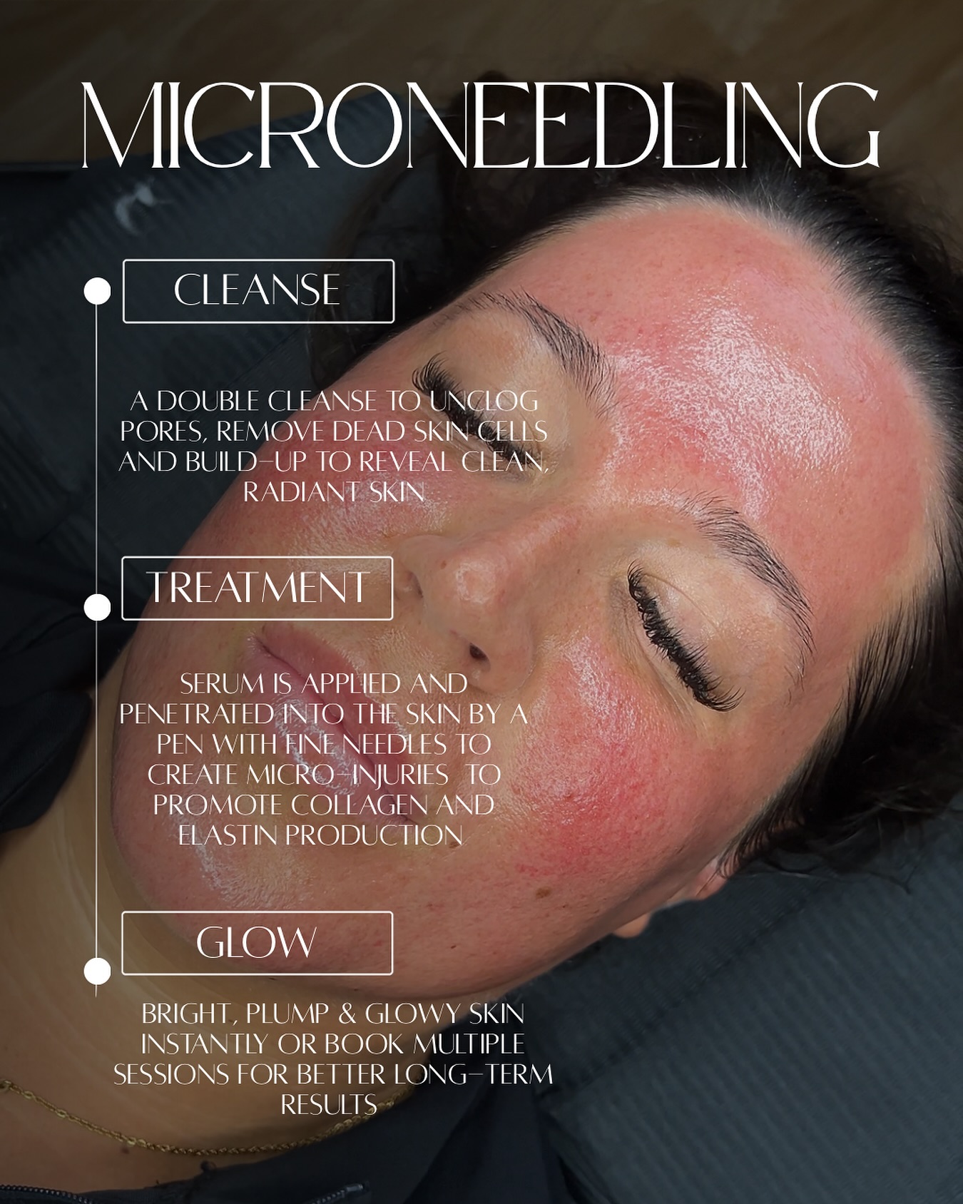 Glow starts beneath the surface ✨
Microneedling works by creating tiny, controlled micro-injuries to stimulate collagen + elastin production—helping to smooth texture, soften fine lines, and restore that natural radiance 💫
Healthy skin is always in style. Book your glow-up today 🤍
#skintreatment #microneedling #skincare #aesthetics #facial
