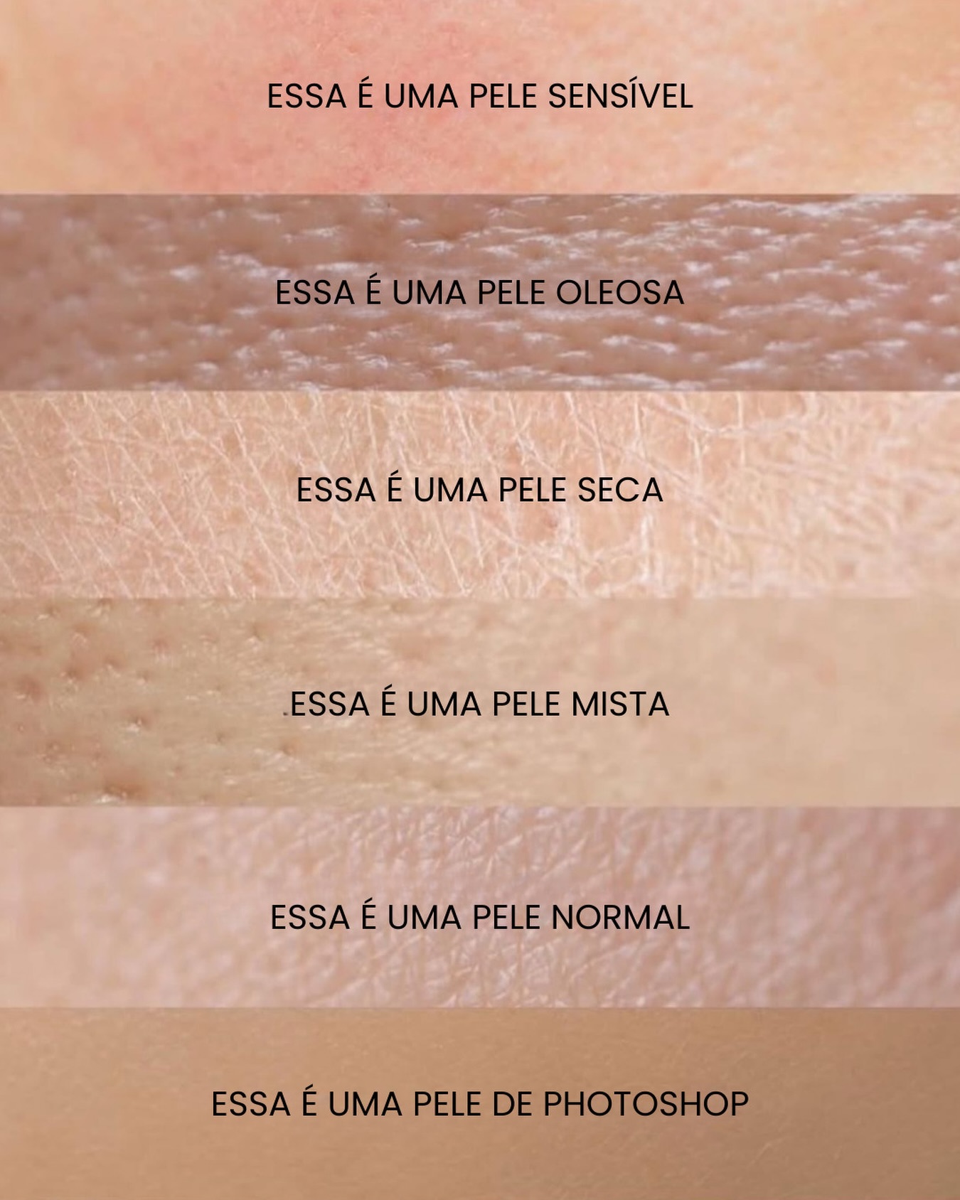 Poros aparentes, oleosidade, ressecamento, pequenas irregularidades, linhas finas… tudo isso faz parte da textura natural da pele real. A ideia de “pele perfeita” muitas vezes vem de filtros e edições, não da realidade.
Cuidar da pele não é sobre apagar detalhes, mas sim melhorar sua qualidade, saúde e equilíbrio ao longo do tempo. Sua pele não precisa ser perfeita, ela precisa ser bem cuidada.
Conte comigo e com a @skinprime_ para te atender com as melhores tecnologias do mercado.
Dr Emmanuel França
Dermatologista
CRM 5999
RQE 636
📍Skin Prime - Riomar Trade Center - Torre 3 - Sala 1905
☎️ (81) 3036-4040