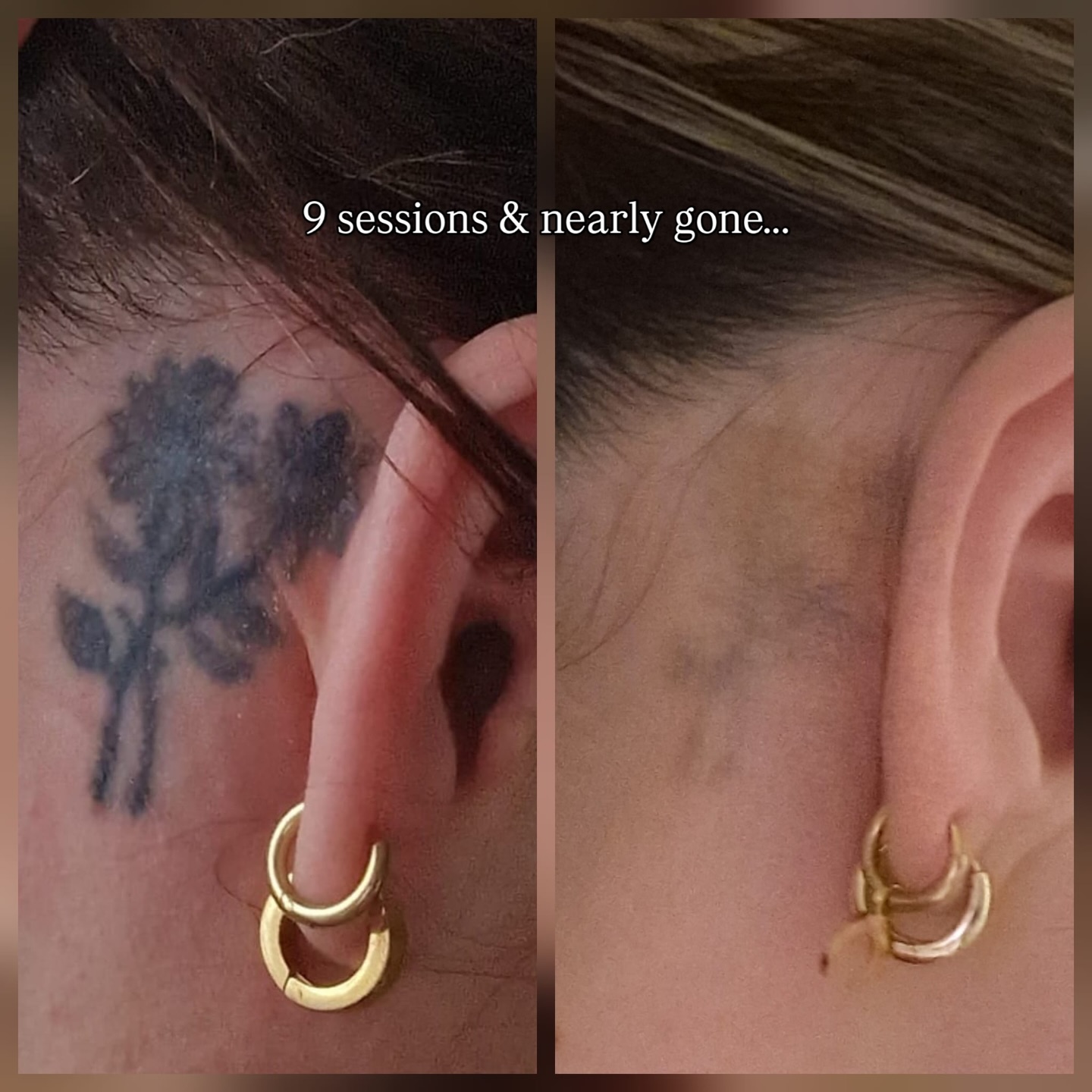 This is what 9 sessions looks like 😍💥
Glasgow! Looking to get a tattoo removed? Look no further.
We offer free consultations to all of our new clients, so we can give you an accurate quote.
Call or text 07542902219 for all booking enquiries.
#tattooscotland #lasertattooremoval #removallaser #glasgowtattoo #laserremoval