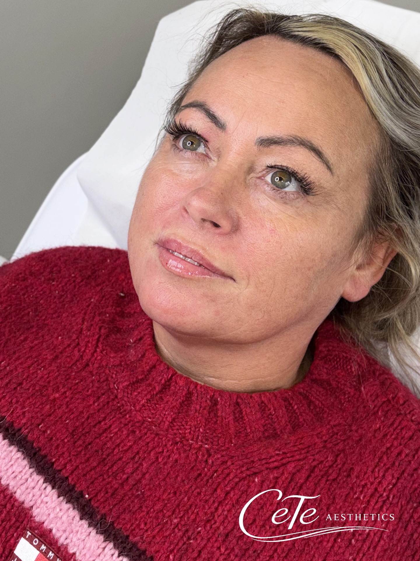 A natural 0.5ml lip enhancement 💉✨
A little swelling is present in the upper lip, which is completely normal at this stage and part of the healing process. This will gradually settle over the next 2 weeks, revealing a soft, balanced, and natural result.
Subtle volume, enhanced shape, still you 🤍
CETE AESTHETICS | Medical Aesthetics Clinic & Training
📍 278 Ashby High Street, DN162RX
📧 chloe@ceteaesthetics.co.uk
——
#lipfillerscunthorpe #lincolnshireaesthetics #scunthorpebusiness #medicalaesthetics #dermalfiller