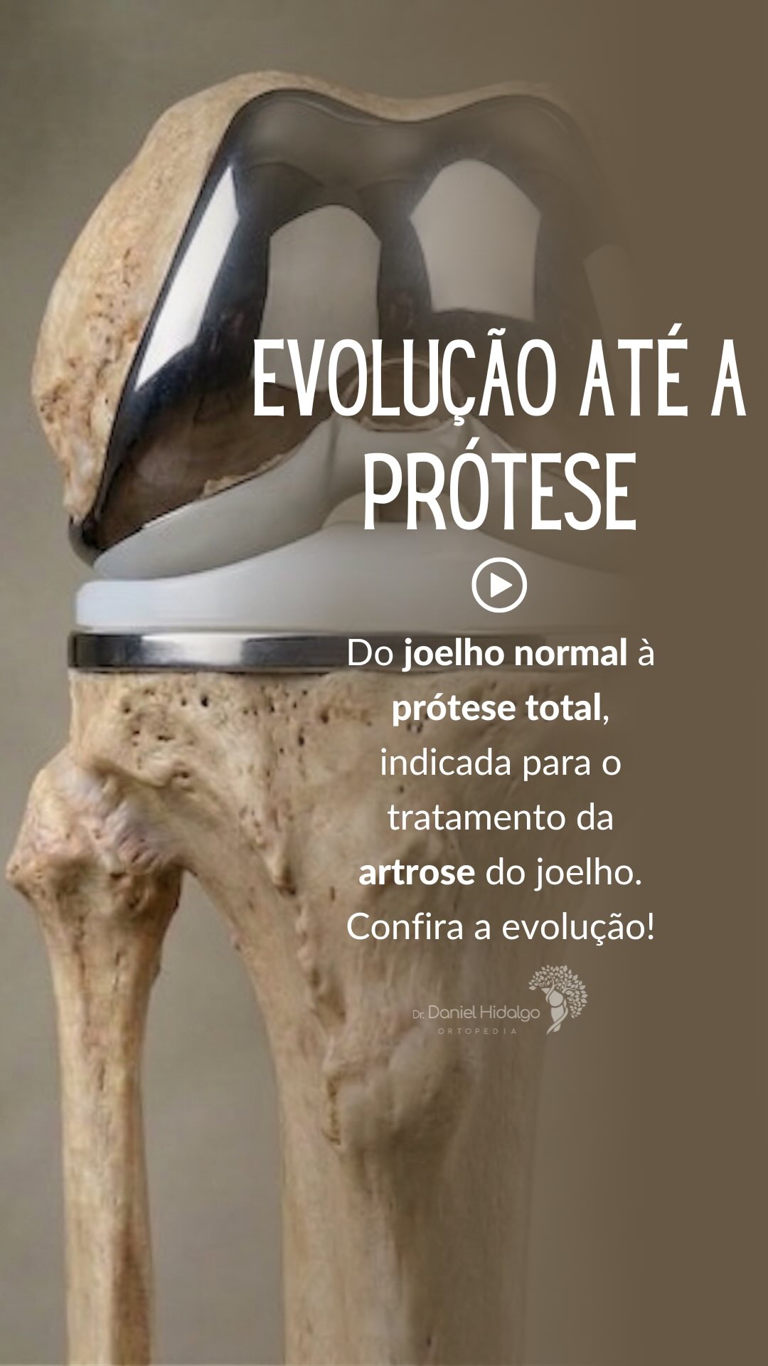 Seu joelho não “estraga” de um dia para o outro.
Tudo começa com o desgaste da cartilagem. O paciente pode evoluir com dor, limitação e, nos casos mais avançados, pode chegar à necessidade de uma prótese total.
A boa notícia?
Na maioria das vezes, é possível intervir antes, com tratamento adequado, fortalecimento e acompanhamento especializado.
Entender essa evolução é o primeiro passo para preservar seu movimento e sua qualidade de vida.
Se você sente dor no joelho, não ignore.
Dr. Daniel Hidalgo - Médico Ortopedista
CRM-SP 137.057 | RQE 41.112
Membro da Sociedade Brasileira de Ortopedia e Traumatologia (SBOT)
Membro da Sociedade Brasileira de Cirurgia do Joelho (SBCJ)
Membro da Sociedade Médica Brasileira de Tratamento por Ondas de Choque (SMBTOC)
#joelho #artrose #ortopedia #protesedejoelho #saude qualidadedevida