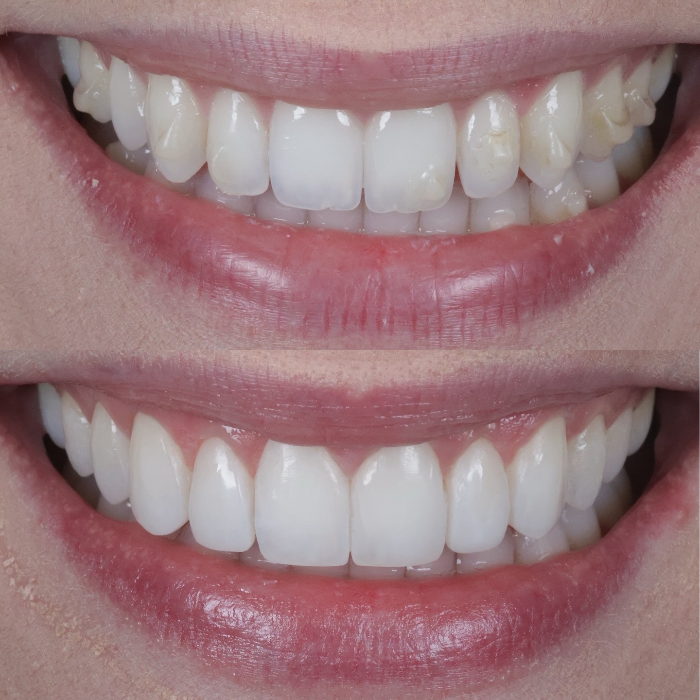 Natural composite bonding on 6 teeth for this lovely patient who was referred to me following her clear aligner treatment.
Her teeth — just enhanced 🤩
DM to start your journey! #naturalbonding #compositebonding #naturalcompositebonding