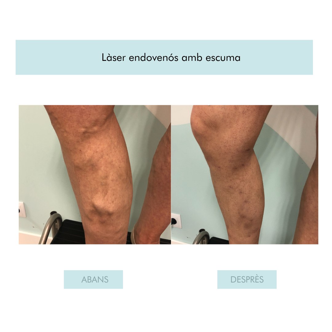 |VENES I VARIUS|
Durant els mesos de menys exposició solar és la millor època per a realitzar-te els tractaments per a eliminar venes i varius.
A partir d'un primer diagnòstic, es pauta el tractament i es van fent sessions cada quinze dies.
Pels casos de venes o d'insuficiència venosa, es pot fer l'endolaser amb escuma per a eliminar-les definitivament. És un procediment que fem en consulta i et permet fer vida normal ràpidament.
#flebologia #flebologianadorra #venes #varius #venetes #dermandtek #dermandtekandorra #dermatologia #angiologia #corporal #cames #tractament #tractamentscorporals