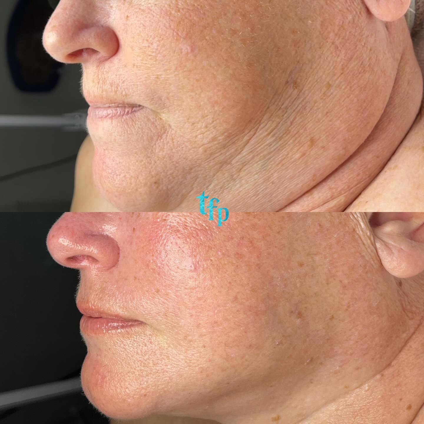 The beauty of a Lift + Firm facial 🩵
🪼The 2 hour lift + firm facial stimulates the facial muscles, drains lymphatic fluid, creates+stimulates collagen and elastin while temporarily lifting and smoothing the skin
This is the best red carpet facial for anyone who wants to smooth out fine lines before a event! 🌊
📲Book on Thefaceplacemi.com
📍Downtown Walled Lake