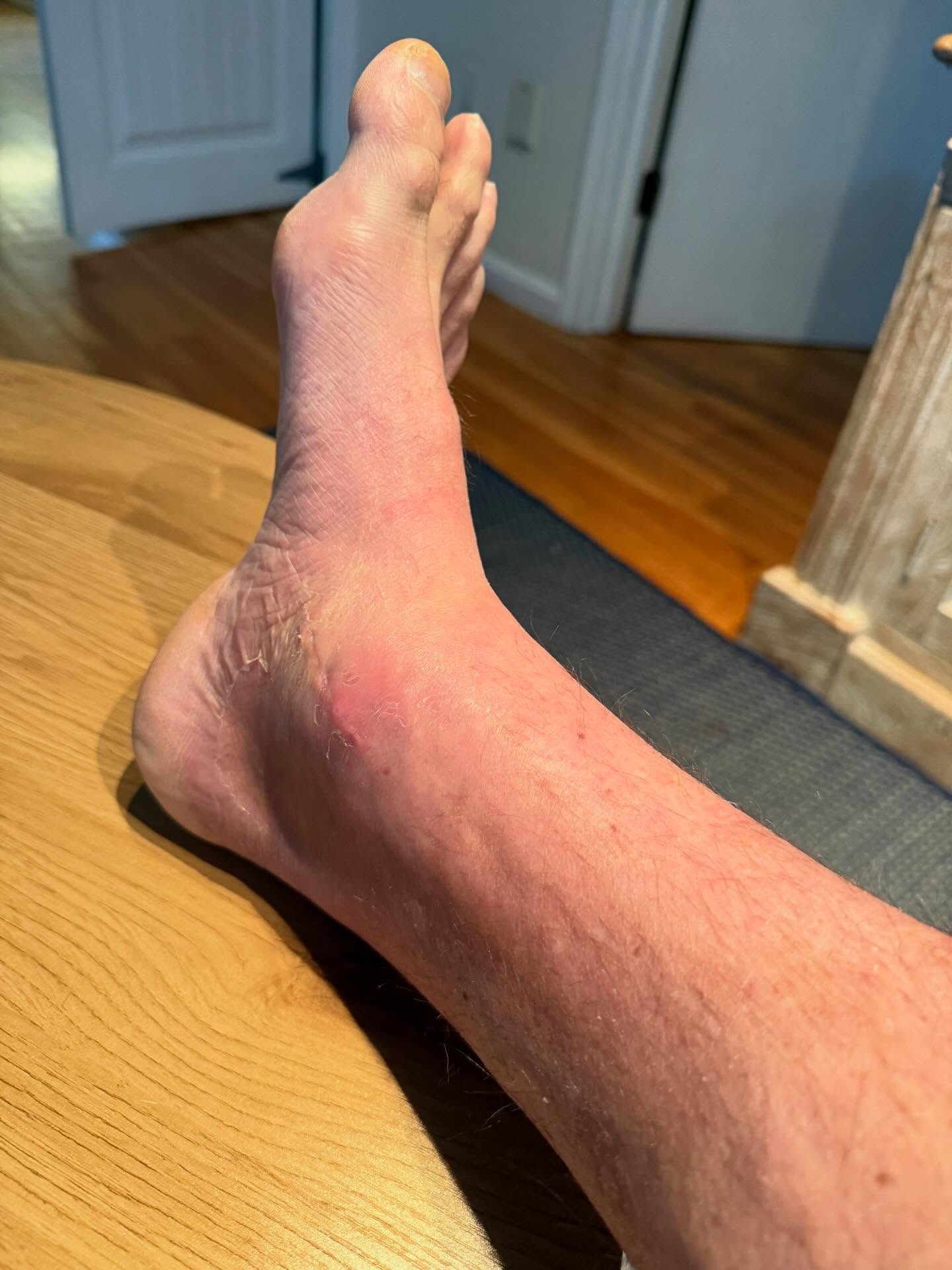 30 days post ORIF ankle surgery
At least 2 weeks ahead of schedule already
Weight bearing and walking with no pan, and already driving!
I wasn’t supposed to be able to do this until 6-8 weeks post op
Only superficial parestheia on the inside of my leg and foot and swelling that goes up and down
I’m on week 1 of doing Softwave therapy and getting adjusted 2x per week at my office
Week 2 of doing physical therapy
And week 3 of my peptide and supplement protocol
The truth is I’m not special
This type of healing isn’t supernatural or lucky
It’s science and common sense
The average person who has surgery NEVER returns to their previous level of activity or function
Mostly because they were already compromised to begin with
But also because they got lazy, discouraged, and made excuses when they got injured and missed the window of opportunity they had to assist the body in its ability to heal optimally
Don’t wait until crisis hits to decide to start doing the work
Life comes at you fast and things are a whole lot harder if you aren’t heathy
If you want my peptide and supplement protocol I used to heal like a superhero comment “Wolverine” and I’ll DM you the stack!