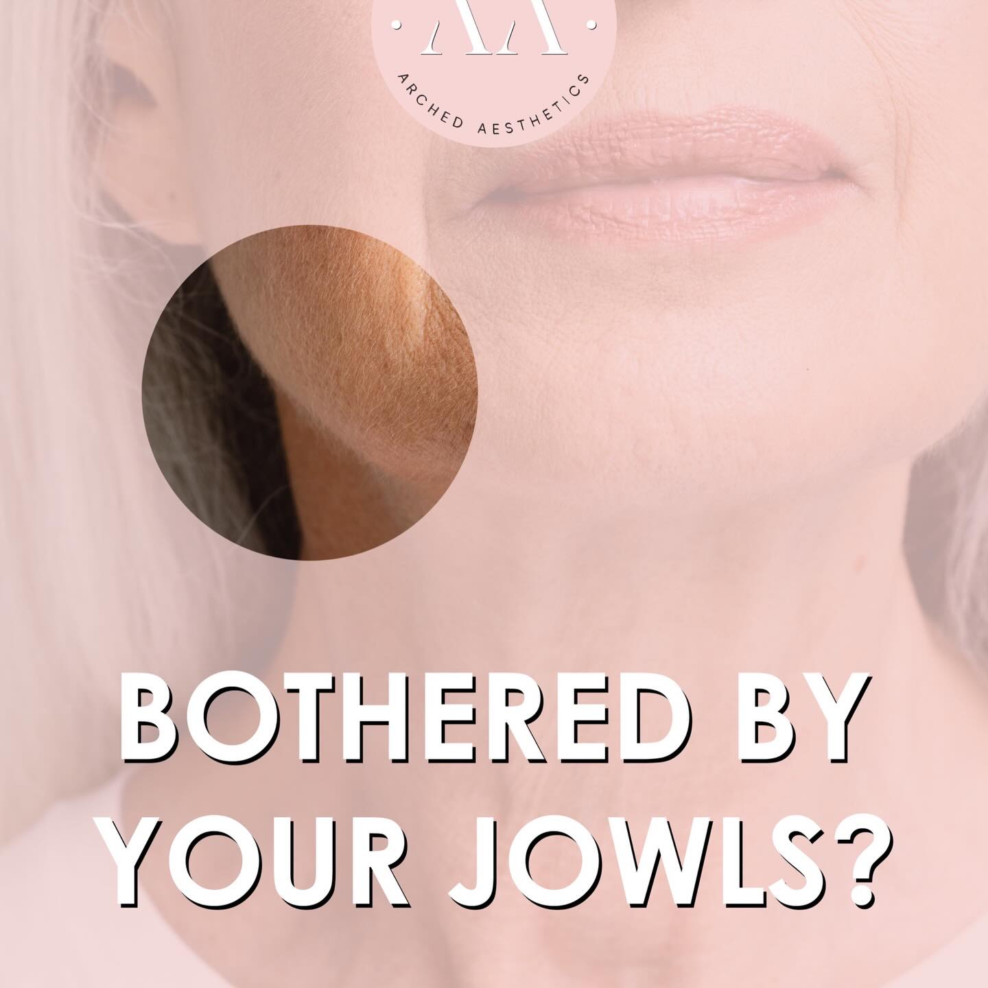 ⠀
Bothered by your jowls? You’re not alone.
Jowling happens as we age due to muscle pull, volume loss, and skin laxity but the good news is there are effective non-surgical options to help restore definition to the lower face.
✨ Two ways we can improve jowls at Arched Aesthetics:
1️⃣ 𝐁𝐨𝐭𝐨𝐱 𝐟𝐨𝐫 𝐩𝐥𝐚𝐭𝐲𝐬𝐦𝐚𝐥 𝐛𝐚𝐧𝐝𝐬
Relaxes the downward pull of the neck muscles, helping the jawline appear smoother and subtly lifted.
2️⃣ 𝐒𝐭𝐫𝐚𝐭𝐞𝐠𝐢𝐜 𝐝𝐞𝐫𝐦𝐚𝐥 𝐟𝐢𝐥𝐥𝐞𝐫
Carefully placed filler in areas such as; cheeks, chin, pre-jowl region and jawline. This restores structure and support, improving sagging from the foundation up.
Every face is different, which is why a full facial assessment is key to achieving natural looking results.
__________________________
Get in touch 👇🏽
𝐃𝐌 𝐔𝐒 𝐅𝐎𝐑 𝐄𝐍𝐐𝐔𝐈𝐑𝐈𝐄𝐒
GIFT VOUCHERS AVAILABLE
SWIPE FOR CLINIC DATES
⭐️ 5 STAR GOOGLE REVIEWS
💻 www.archedaesthetics.co.uk
📱 𝗪𝐇𝐀𝐓𝐒𝐀𝐏𝐏 07517416782
📧 hello@archedaesthetics.co.uk
#lipfillerplymouth #dermalfillerplymouth #aestheticscallington #dermalfillercallington #aestheticsliskeard