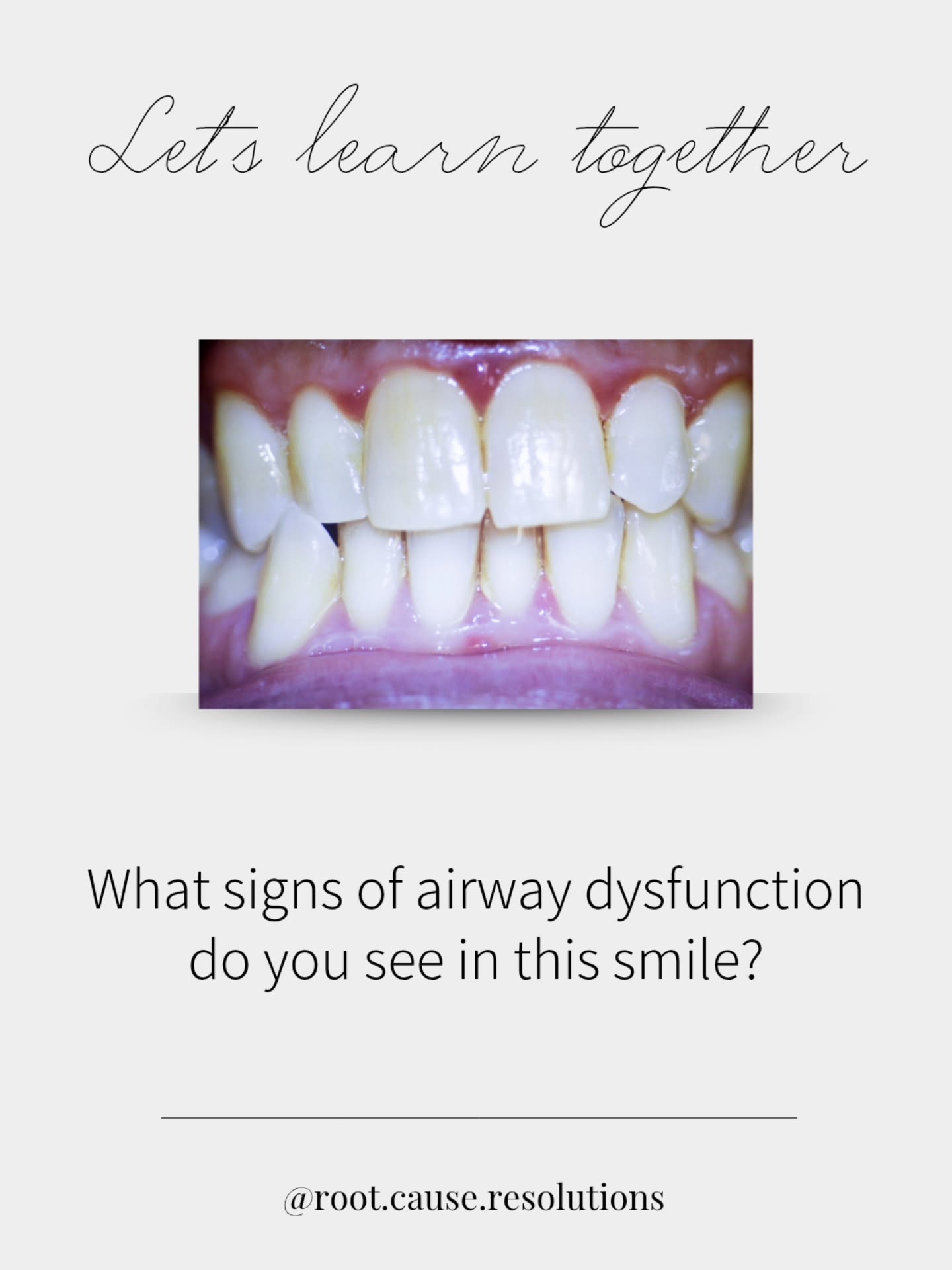 How many patients with a mouth like this are sitting in your chair, undiagnosed and untreated?
‼️This isn’t just a dental case. It’s an airway story.
🌟We’ve been trained to look at teeth. It’s time to start seeing the system.
What do YOU notice first when you see this?
#airwaydentistry #wholebodyhealth #oralhealth #myofunctionaltherapy #RDH