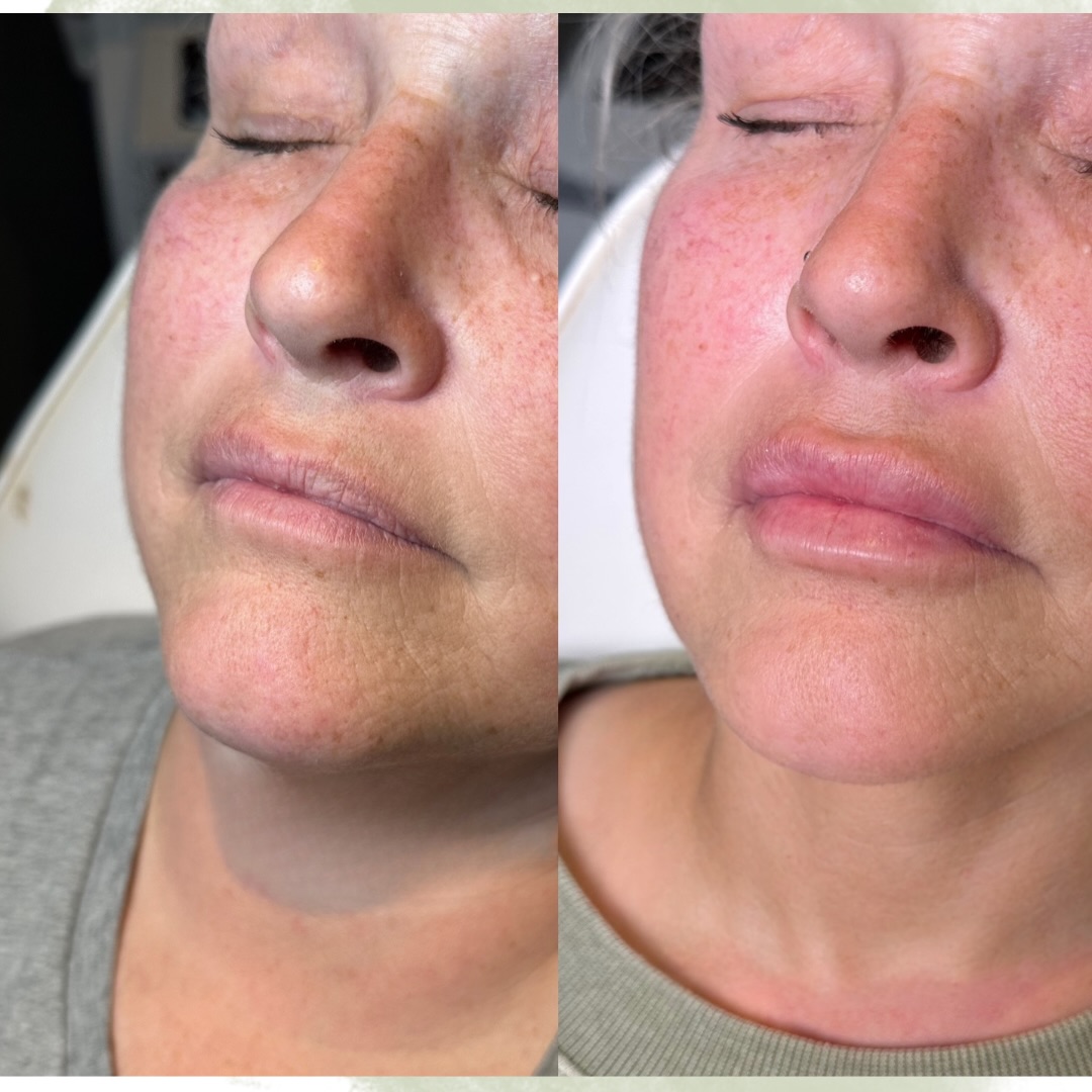 Plump and perfect
1 full syringe to reach her goals 😍
#lips #lipfillerbeforeandafter #lipfillers #sudbury #nurseinjectors